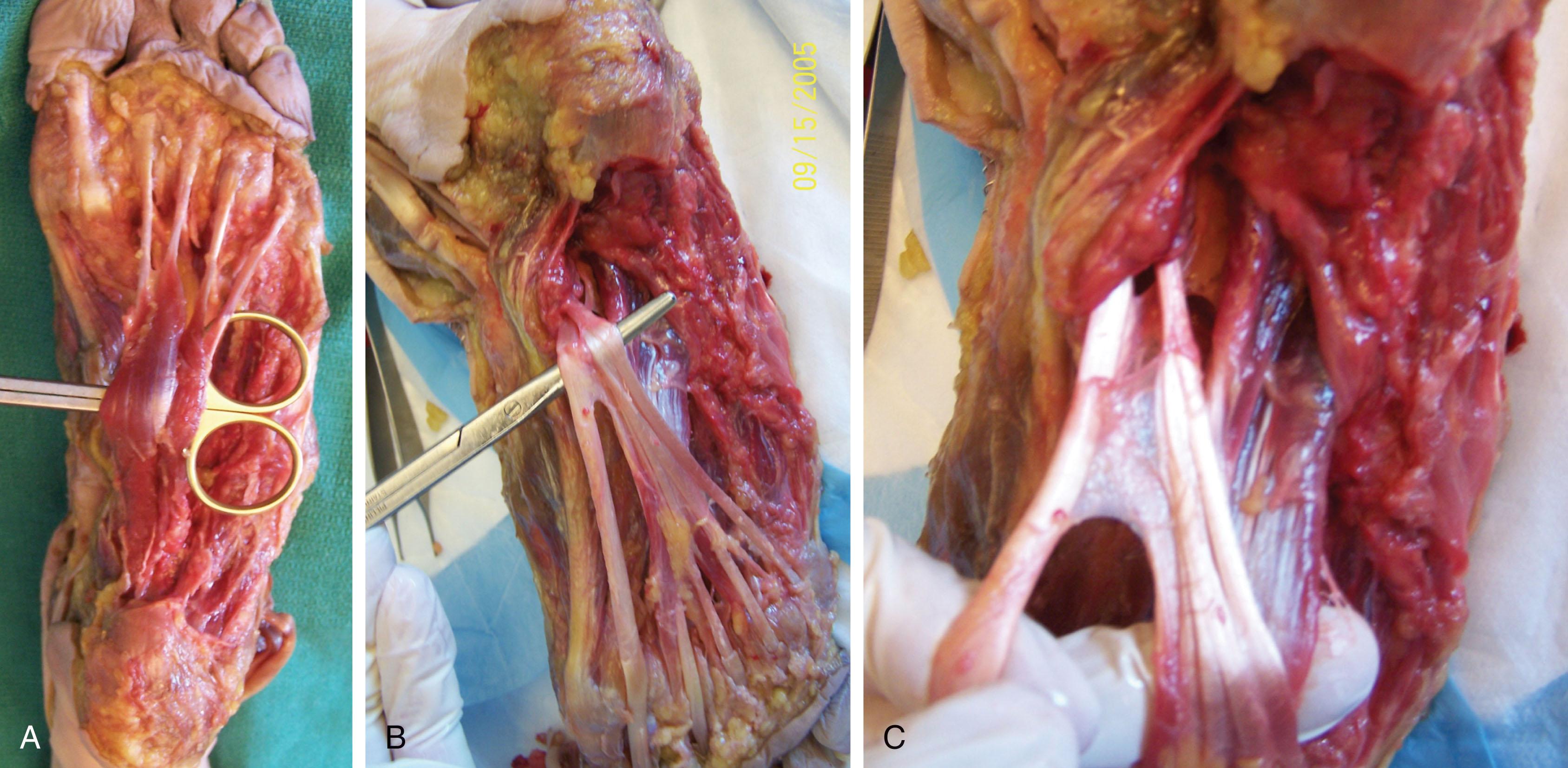 Fig. 28-53, Anatomic dissection demonstrates tendon connection between the flexor hallucis longus (FHL) and flexor digitorum longus (FDL). A , FDL. B , Minor connection between FHL and FDL. C , Close-up view.