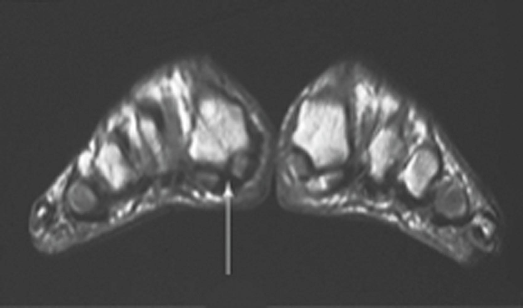 Fig. 28-54, A coronal view of a magnetic resonance image demonstrating distal flexor hallucis longus rupture (arrow) .