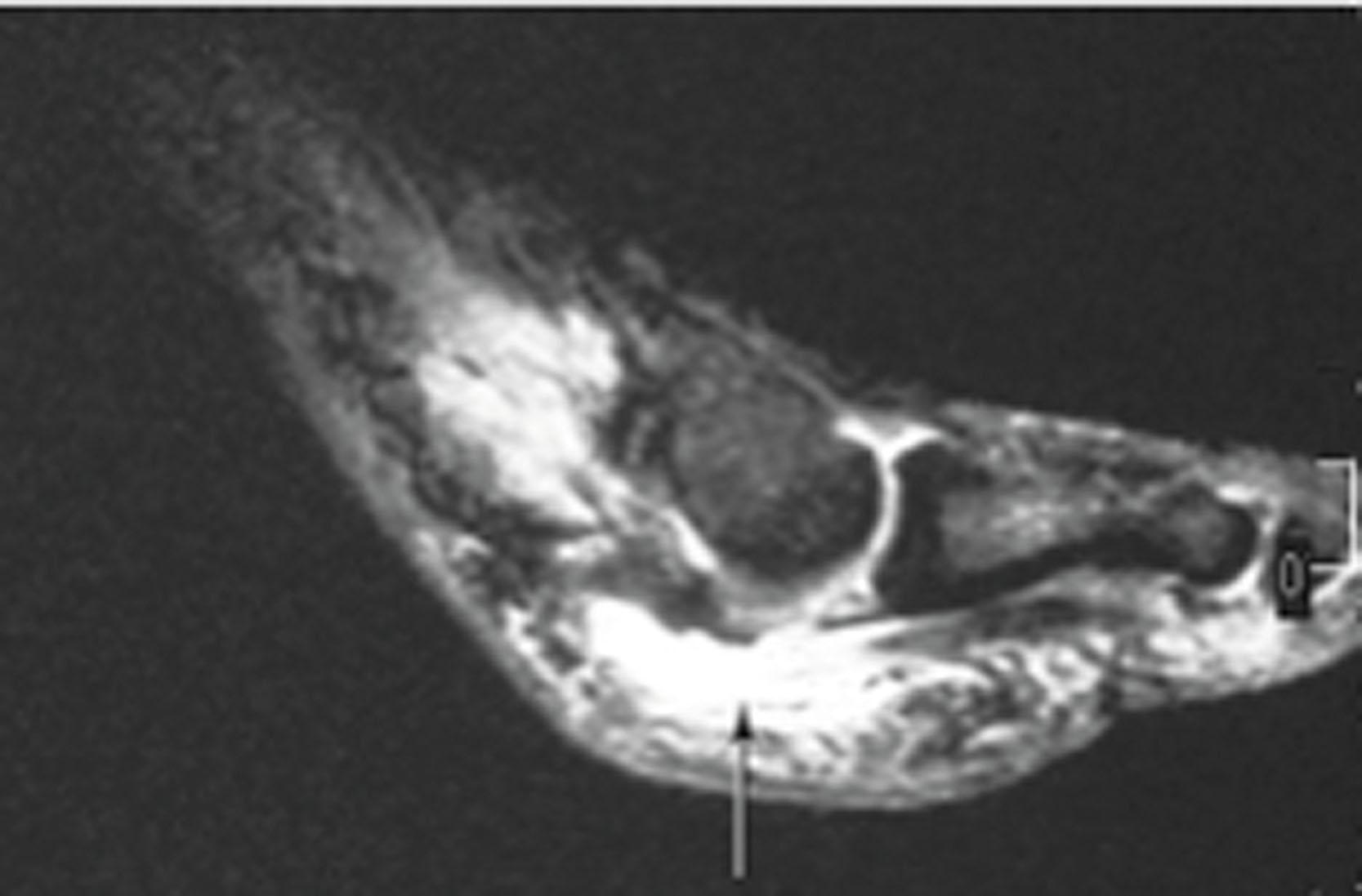 Fig. 28-55, A sagittal view of a magnetic resonance image demonstrating distal flexor hallucis longus rupture (arrow) .