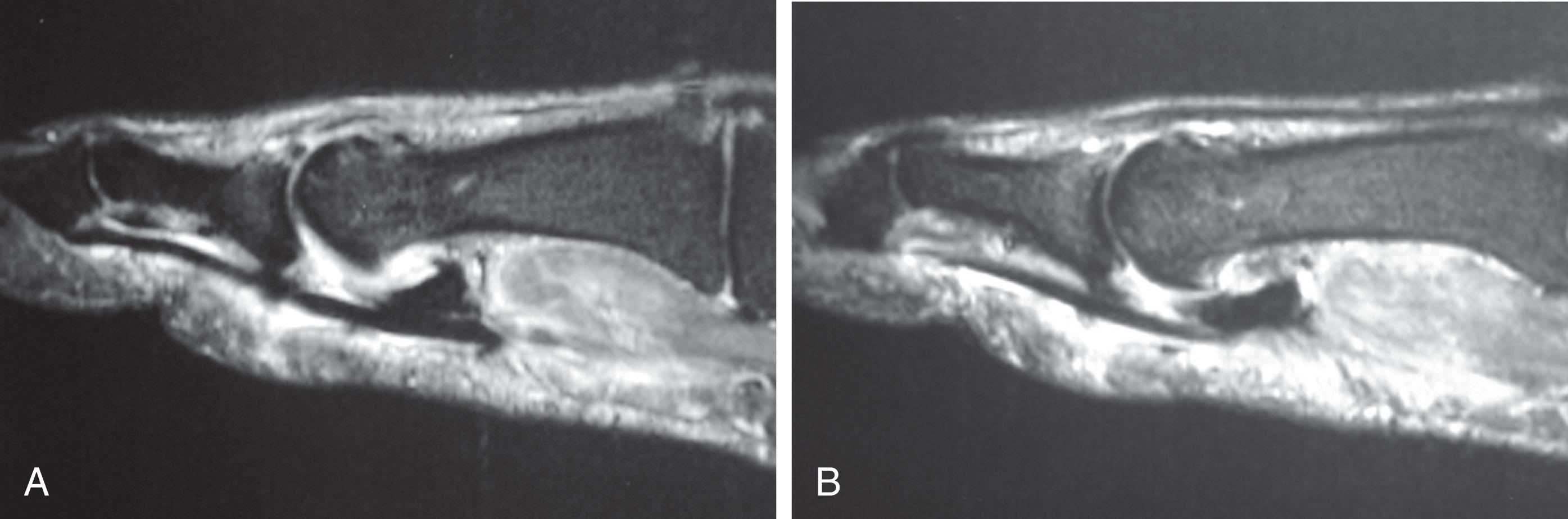 Fig. 28-56, A , Sagittal view of the first metatarsophalangeal joint on a magnetic resonance image showing flexor hallucis longus (FHL) tenosynovitis. The FHL can be traced from beneath the sesamoid to the base of the proximal phalanx. The sesamoidal phalangeal ligament, which is the continuation of the flexor hallucis brevis tendon, is absent, indicating rupture. B , The medial sesamoid shown here has retracted proximally and is no longer under the metatarsal head. The sesamoidal phalangeal ligament and plantar plate has ruptured. The FHL is visualized plantarly, surrounded by edema from the ligament and plantar plate rupture. The extensor hallucis longus can be seen dorsally.