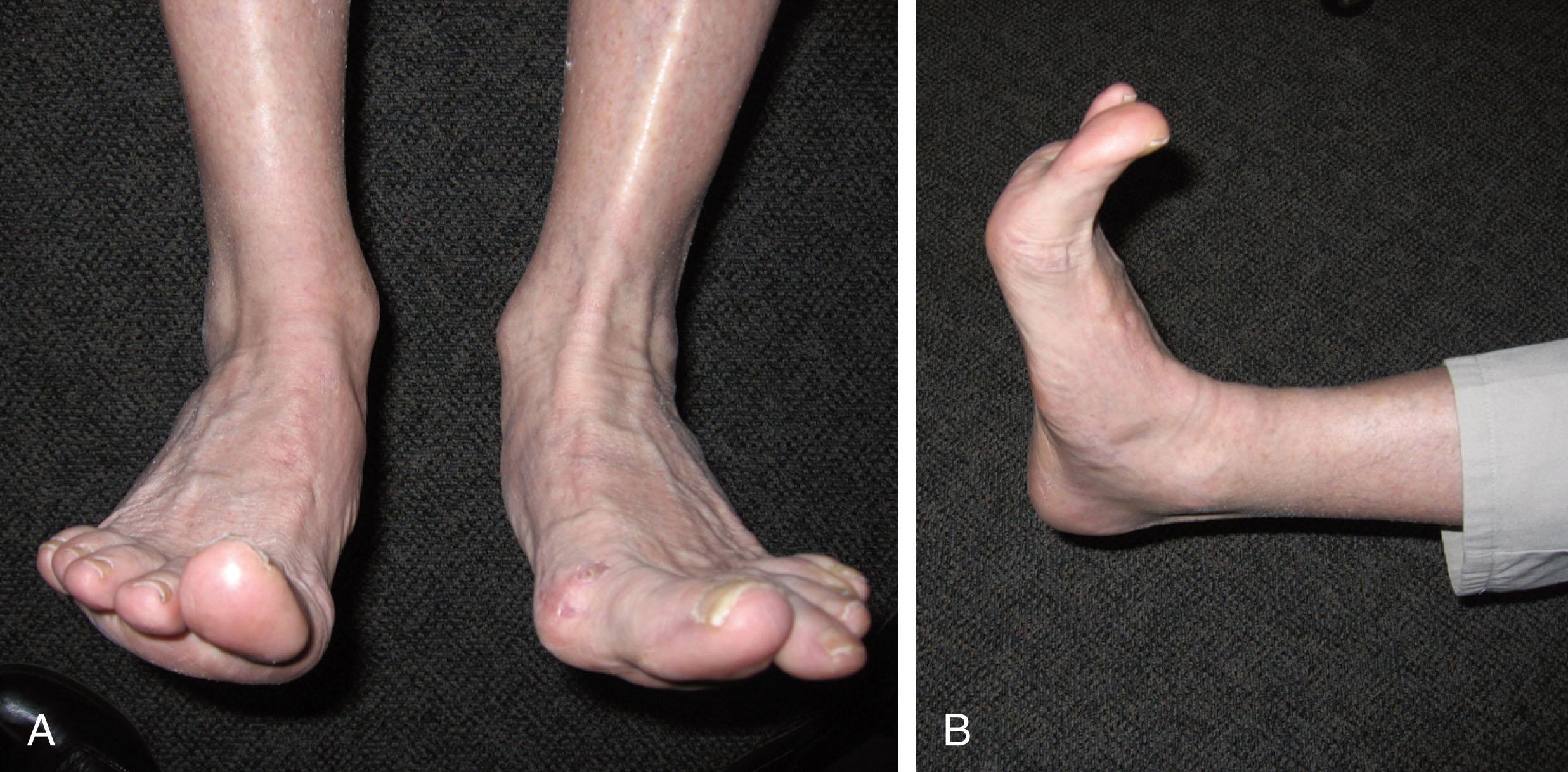 Fig. 28-6, A , Intact anterior tibial tendon on the left foot, rupture on the right. B , The extensor digitorum longus and extensor hallucis longus are recruited to dorsiflex the ankle. Note extension of toes with ankle dorsiflexion. The injured ankle dorsiflexes less and everts more because of the tendon imbalance. The medial ray is still relatively plantar flexed.