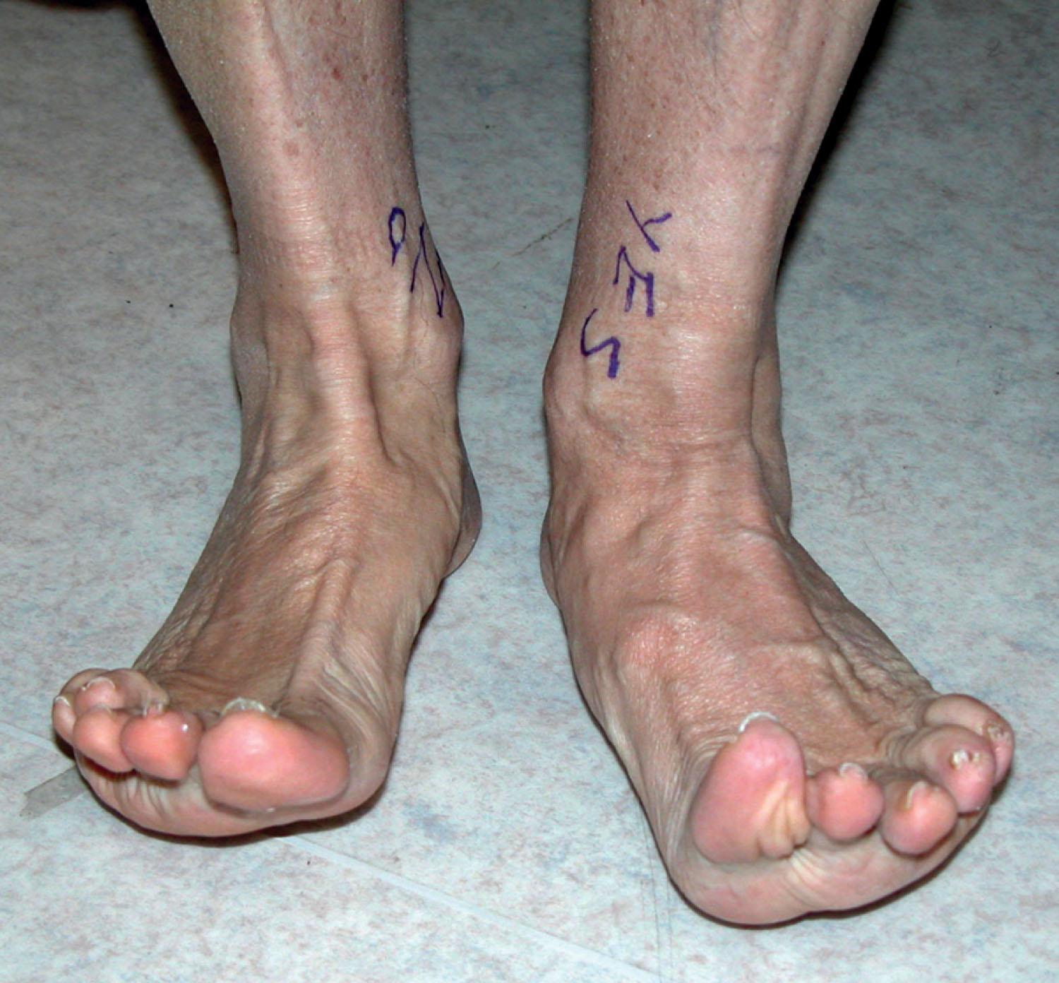 Fig. 28-7, The left ankle has neutral dorsiflexion with compensatory over pulling of the EHL and EDL. The forefoot is in valgus and midfoot in eversion relative to the right side. EDL , Extensor digitorum longus ; EHL , extensor hallucis longus .