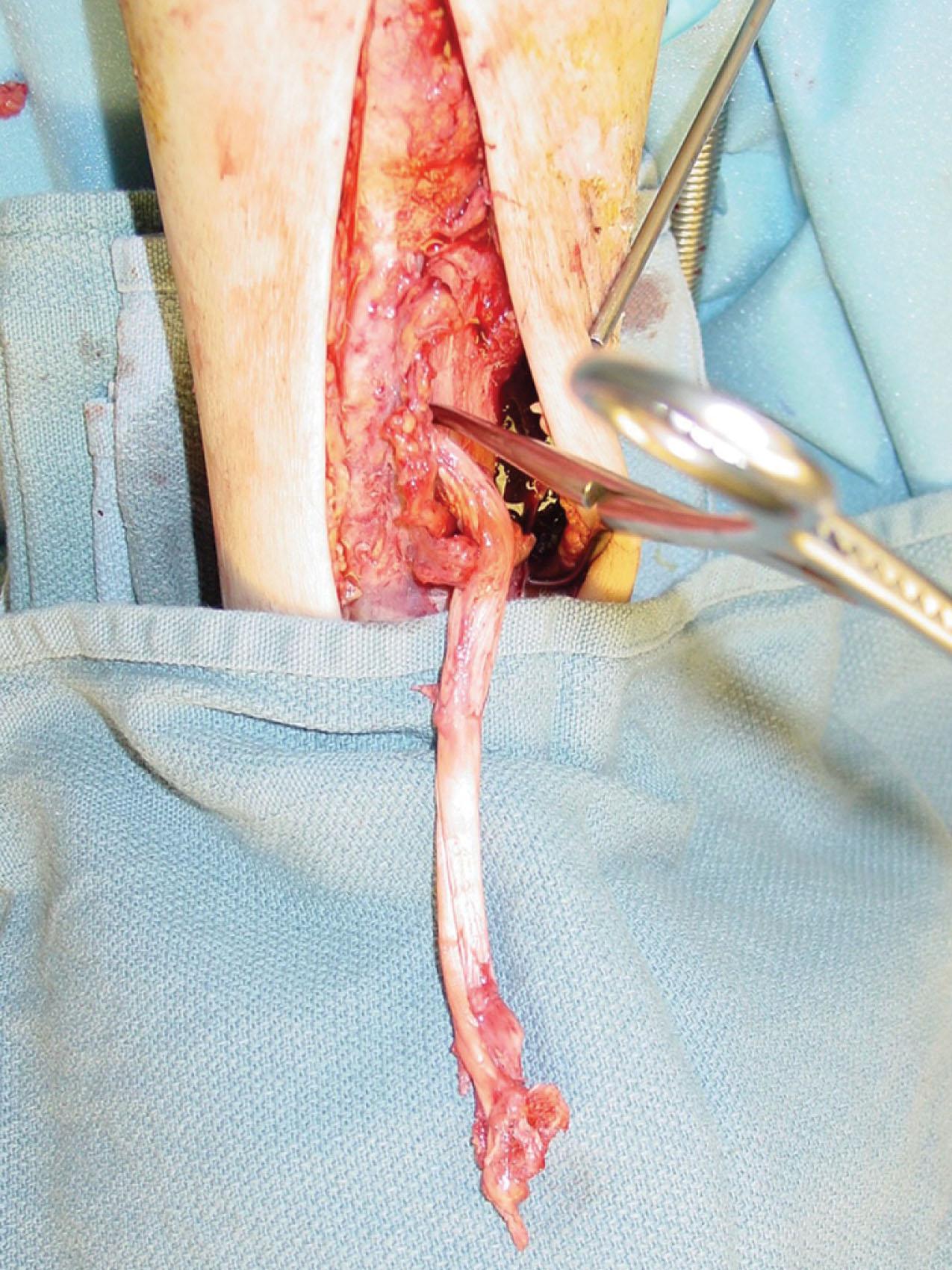 Fig. 28-8, Fractured distal tibia with avulsion of anterior tibial tendon. Open exposure of tibial fracture (knee superior, ankle inferior). The anterior tibial tendon was avulsed with a bony fragment from the medial cuneiform and base of the first metatarsal, and interposed in the fracture site, preventing reduction.