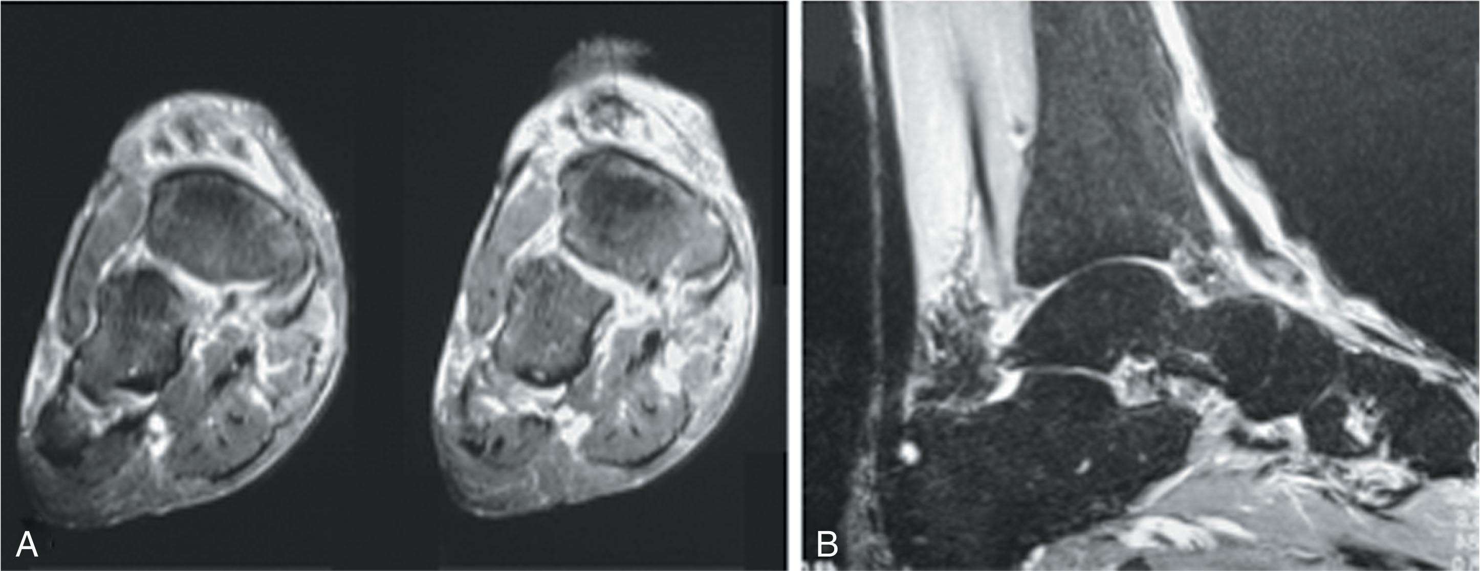 Fig. 28-9, Magnetic resonance image demonstrates rupture of the left anterior tibial tendon off its insertion. A , At the level of the naviculum, the anterior tibial tendon is indistinct dorsomedially. B , Sagittal view demonstrates the anterior tibial tendon, which appears wavy because of loss of tension. It is surrounded by synovial fluid, and distally the tendon cannot be traced, ending abruptly in a widened fibrotic mass just dorsal to the naviculum.