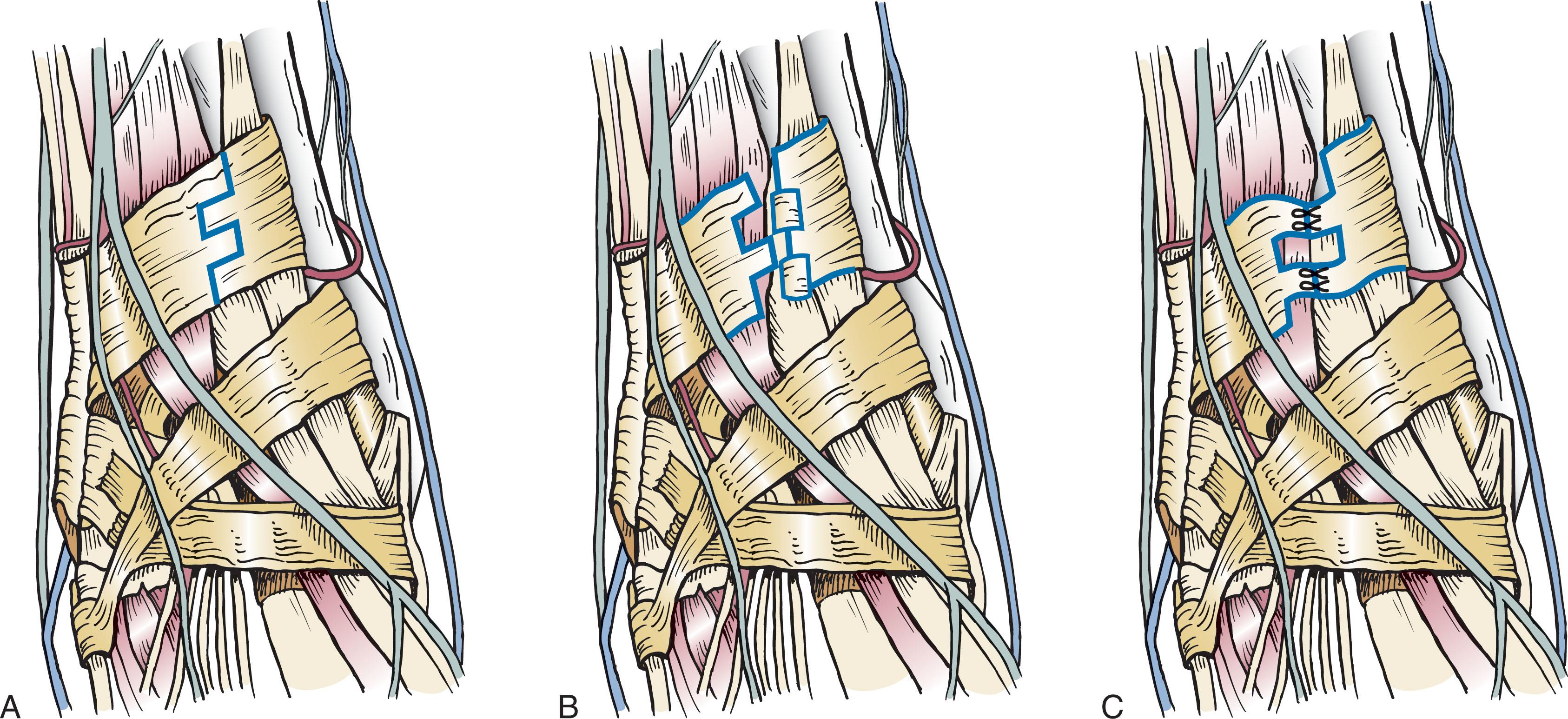 Fig. 28-10, A , The retinaculum is cut in a step-cut fashion. This allows exposure of the extensor tendons below. B , The square wave is then closed with the squares shifted so that the extra capacity is achieved to make room for a tendon reconstruction. C , After repair of retinaculum in lengthened fashion.