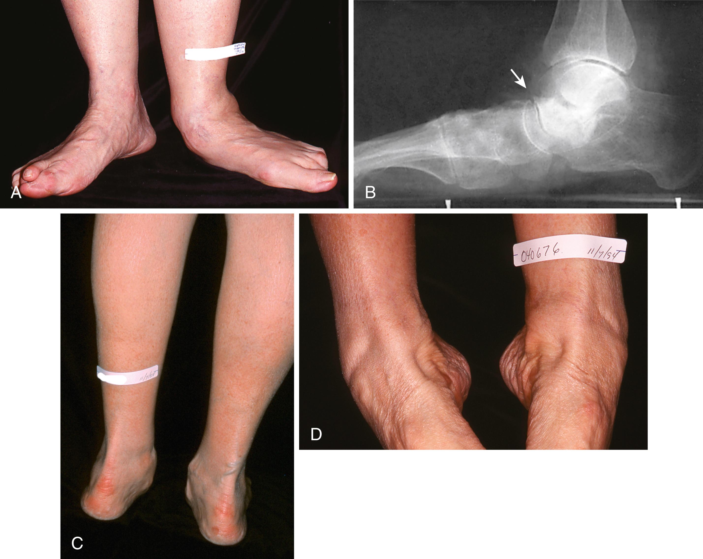 FIGURE 83.1, A, Patient with asymmetric pes planus. B, Talus slides distally, medially, and plantarward with loss of posterior tibial tendon and probable insufficiency of plantar calcaneonavicular ligament. C, Long-standing deformity. Achilles tendon contracture exacerbates heel valgus. D, In sitting position, when asked to hold foot in plantarflexion-inversion after being placed there passively by examiner, patient unconsciously used anterior tibial tendon. Also note increased supination (forefoot varus relative to longitudinal axis of calcaneus).