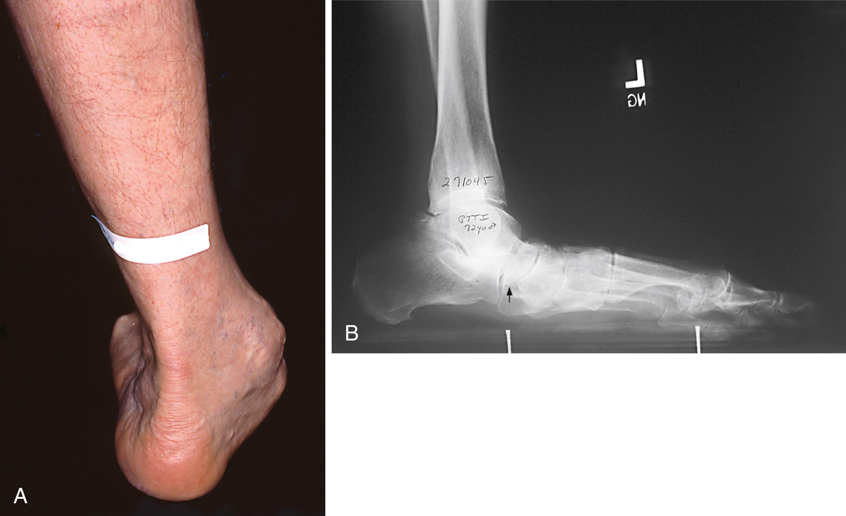 FIGURE 83.11, Attritional rupture of posterior tibial tendon at medial malleolus with arch collapse of unknown duration. A, Typical clinical findings of complete rupture of this tendon. B, Radiograph shows almost 90-degree rotation of talus.