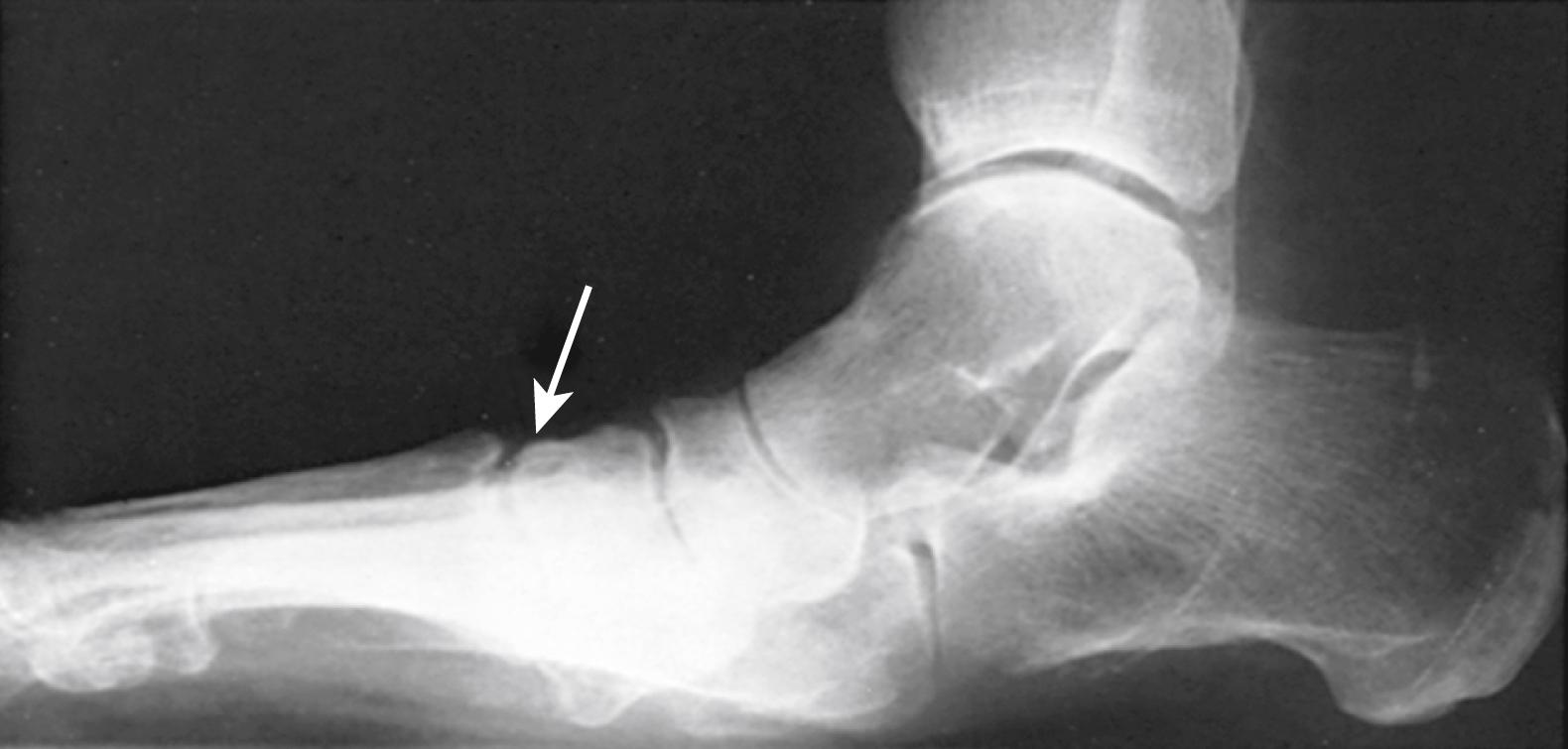 FIGURE 83.12, This foot mimicked arch collapse secondary to posterior tibial tendon disruption. Primary collapse was tarsometatarsal with secondary hindfoot collapse from osteoarthritis.