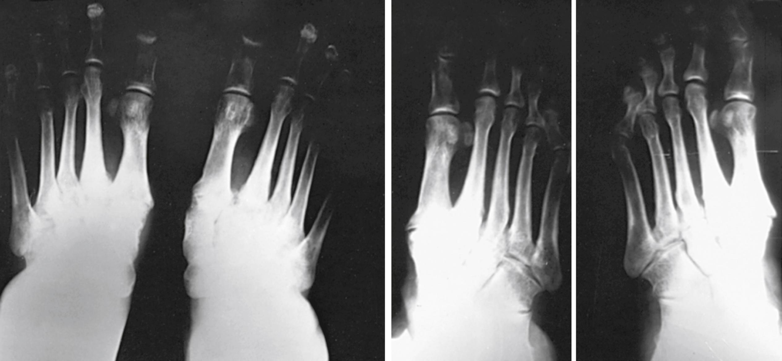 FIGURE 83.14, Anteroposterior and oblique radiographs showing degenerative arthritic changes at Lisfranc joints with resultant collapse deformity at these articulations. This probably represents erosive osteoarthritis with secondary enthesopathy and weakening of plantar metatarsal cuneiform, metatarsal cuboid, and intermetatarsal basilar ligaments.