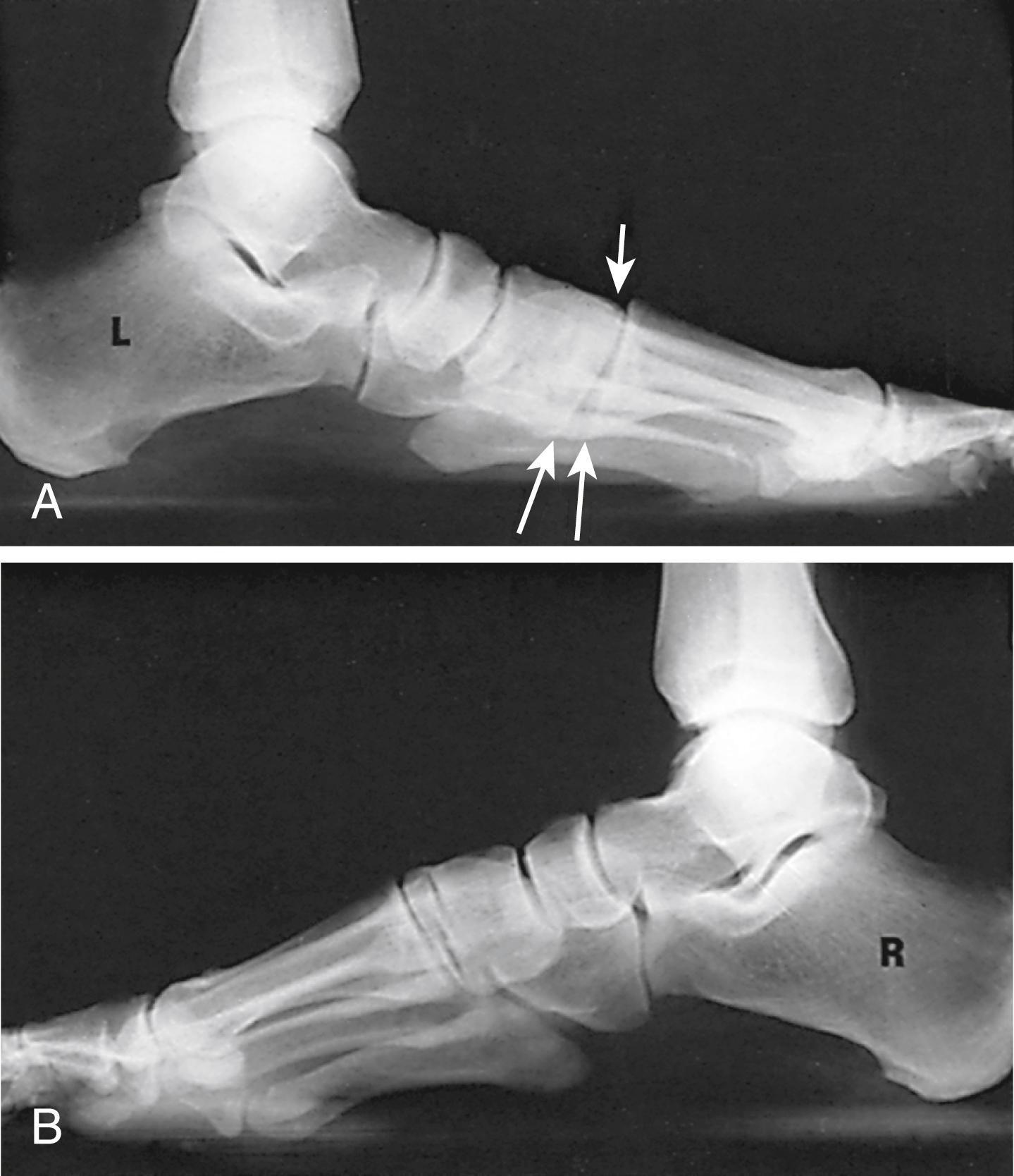 FIGURE 83.15, This 64-year-old carpenter felt pop in midfoot and noticed some time later flattened, pronated foot. Clinically, picture resembled posterior tibial tendon insufficiency, but tendon was intact. A, Radiographic weight-bearing view showed widening of metatarsal-cuneiform articulation plantarward and collapse at this articulation. B, Note also overlapping of metatarsals compared with uninjured right foot, indicating pronation of forefoot.