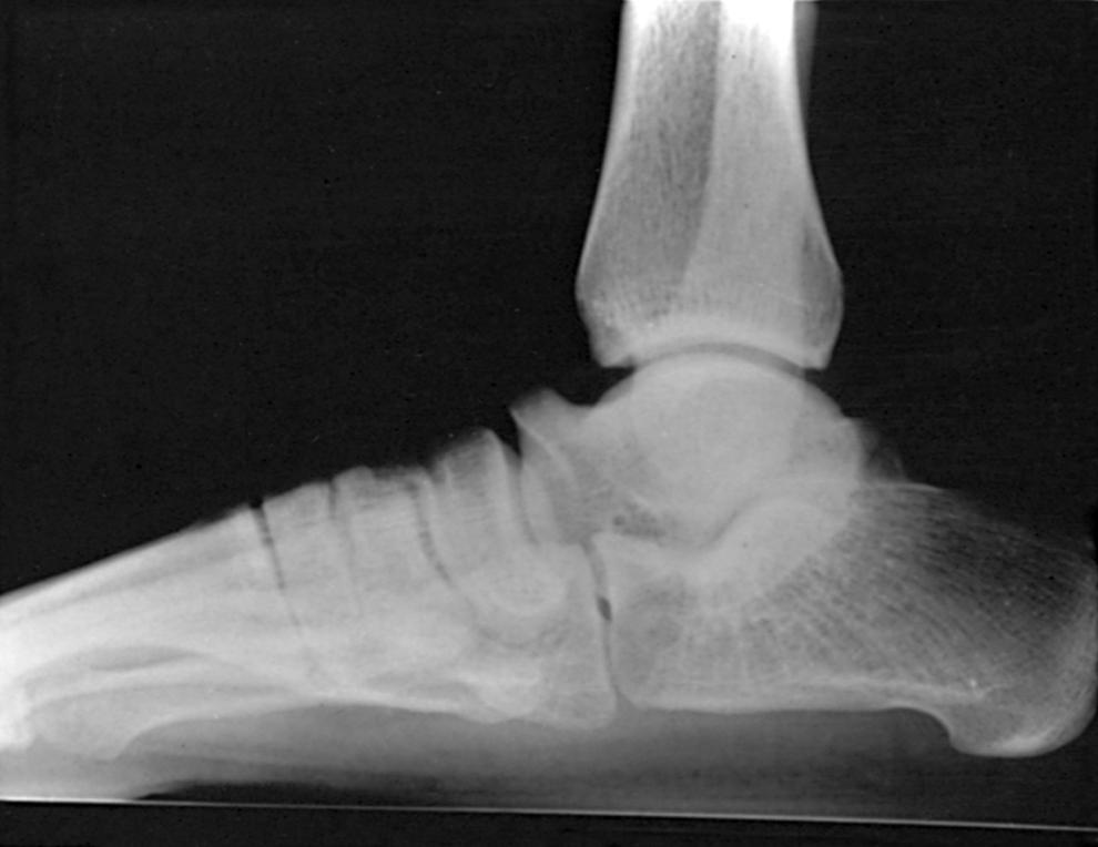 FIGURE 83.16, Middle facet tarsal coalition; note beaking of neck of talus and “C” sign.