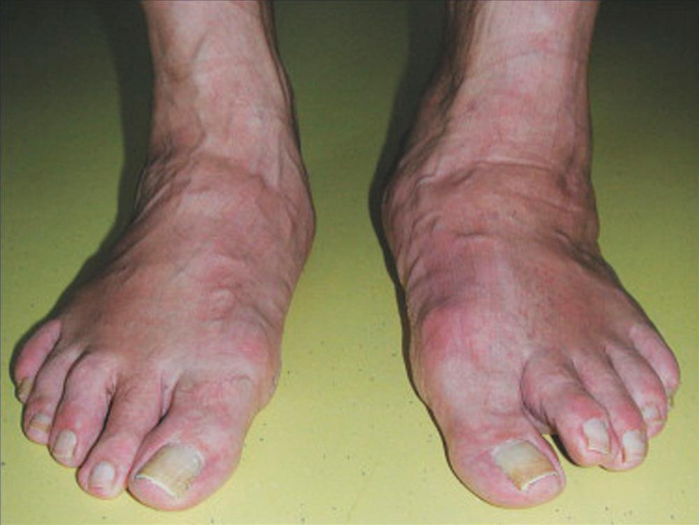 FIGURE 83.17, Collapse of medial longitudinal arch (left foot) resulting from diabetic neuropathy.