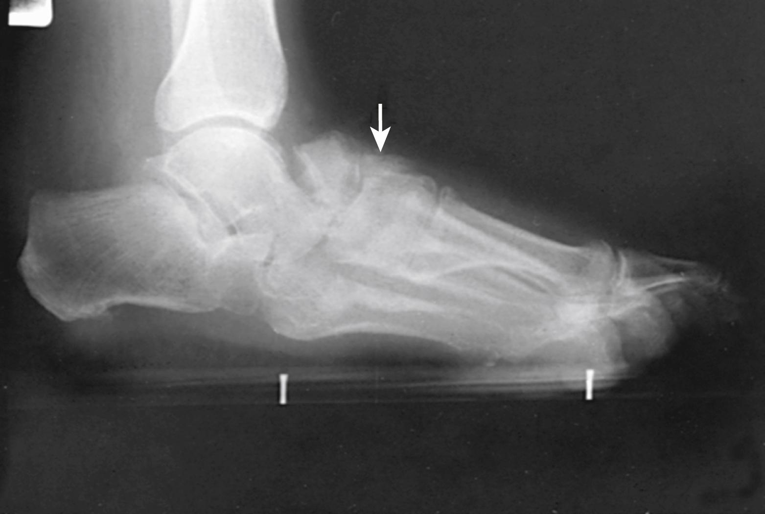 FIGURE 83.18, Standing lateral radiograph showing fracture and fragmentation of navicular with collapse of talus into resulting defect. Arrow points to attempted healing of fractures.