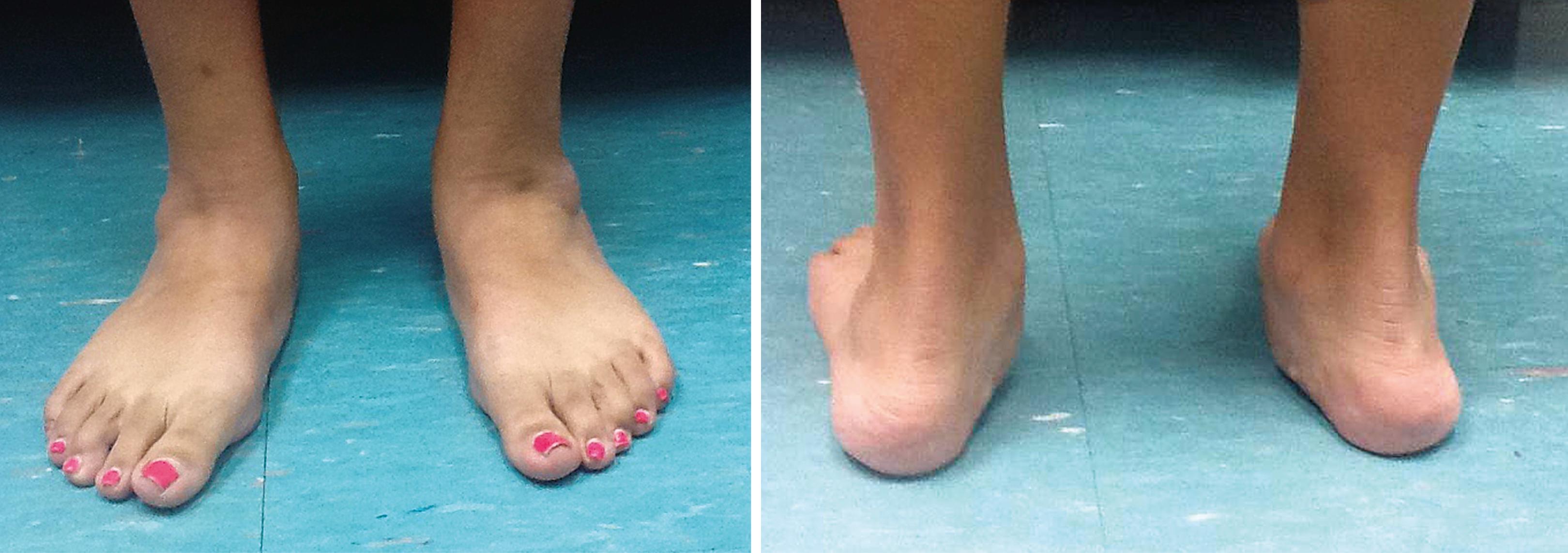 FIGURE 83.19, Idiopathic flexible flatfoot in adolescent patient.