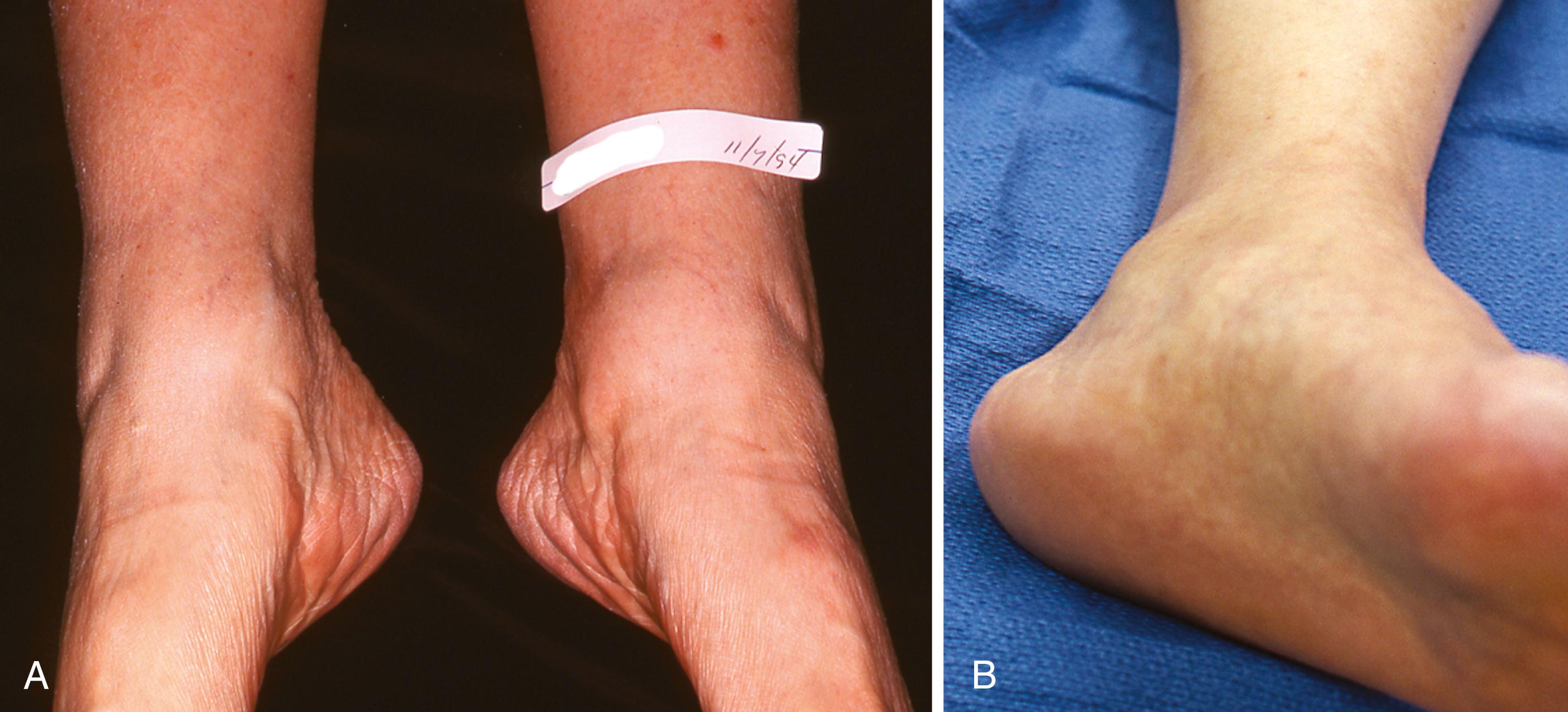 FIGURE 83.20, A, Persistent posterior tibial tenosynovitis on left was unresponsive to many weeks of casting and several months of double upright brace wear with medial T-strap. Note fullness behind medial malleolus on left not seen on right. B, Closer view of medial aspect of left ankle showing area of tenosynovitis.