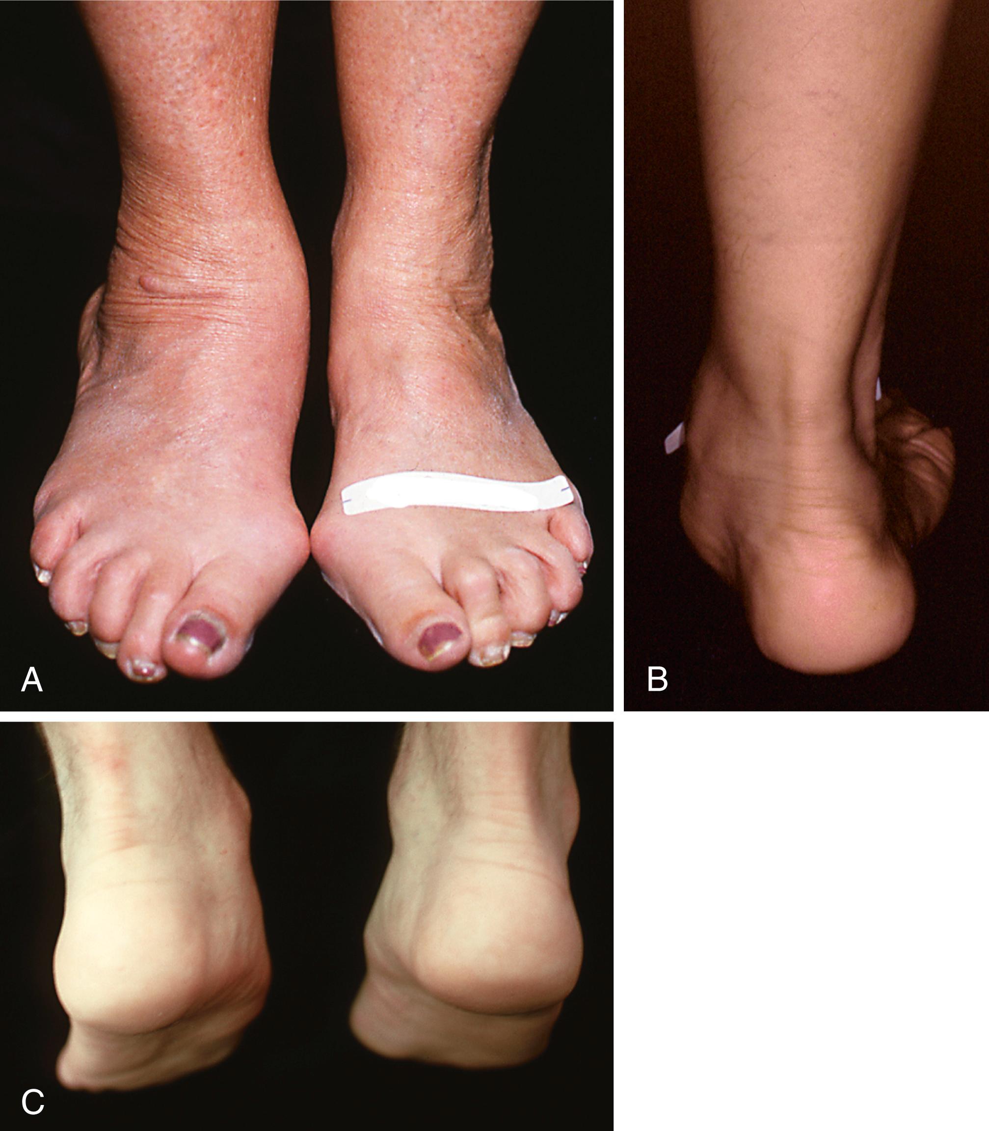 FIGURE 83.2, Patients with posterior tibial tendon insufficiency as result of attritional loss of continuity. Note that one or more of three major components of deformity may be excessive. A, Right heel is in some valgus and forefoot is pronated, but note marked midfoot abduction. This is important to note because not only would tendon transfer-substitute for posterior tibial tendon not correct this deformity, but also subtalar arthrodesis with heel in neutral would leave this component uncorrected. B, Standing position emphasizes multiple-plane deformity. C, Note convexity of medial side and concavity of lateral side on left foot.