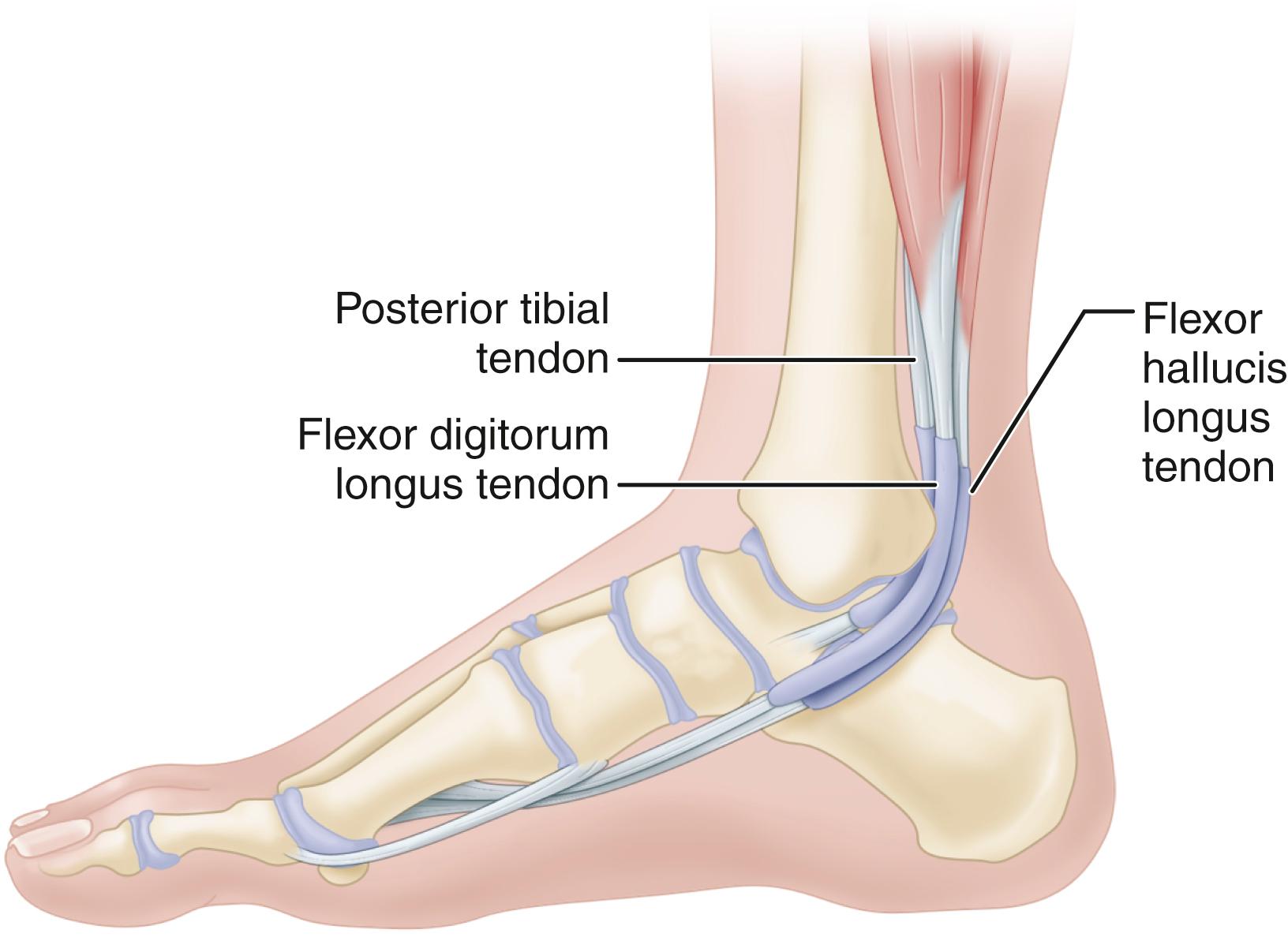 FIGURE 83.22, Technique for tendon transfer. Incision starts just behind musculotendinous border of posterior tibial tendon and courses behind medial malleolus to base of first metatarsal medially. SEE TECHNIQUE 83.2.