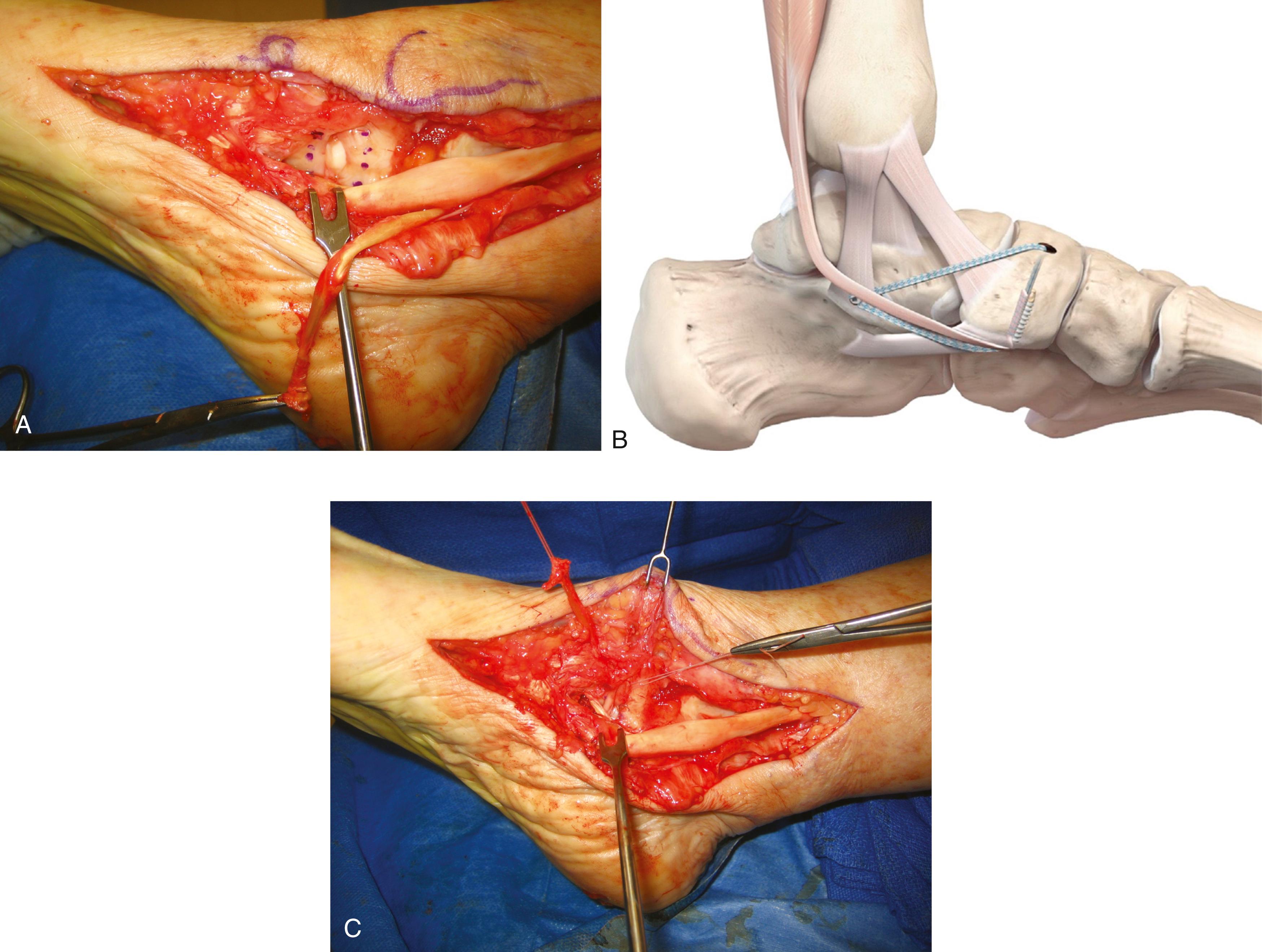 FIGURE 83.24, Repair of spring ligament. A, Portion of spring ligament to be excised. B, Nonabsorbable suture tape to augment primary repair or spring ligament. C, Repaired ligament. SEE TECHNIQUE 83.3.