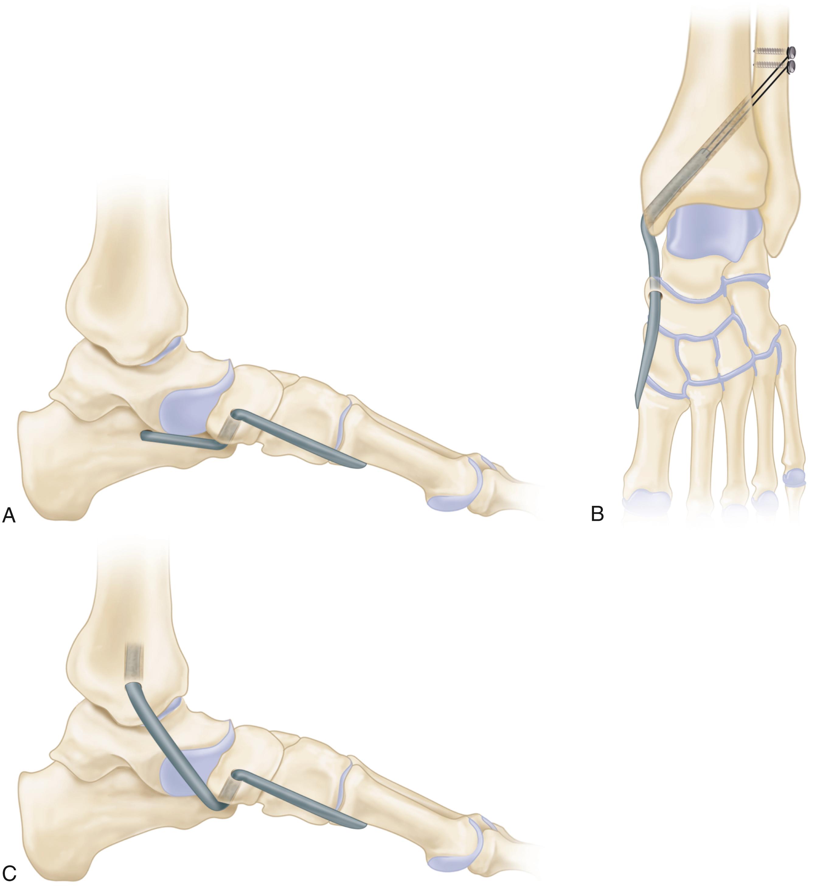 FIGURE 83.25, Reconstruction of spring ligament using peroneus longus autograft tendon transfer. A, Medial view showing calcaneal bone tunnel reconstruction. B, Anteroposterior view showing tibial bone tunnel reconstruction. C, Medial view of tibial bone tunnel reconstruction.