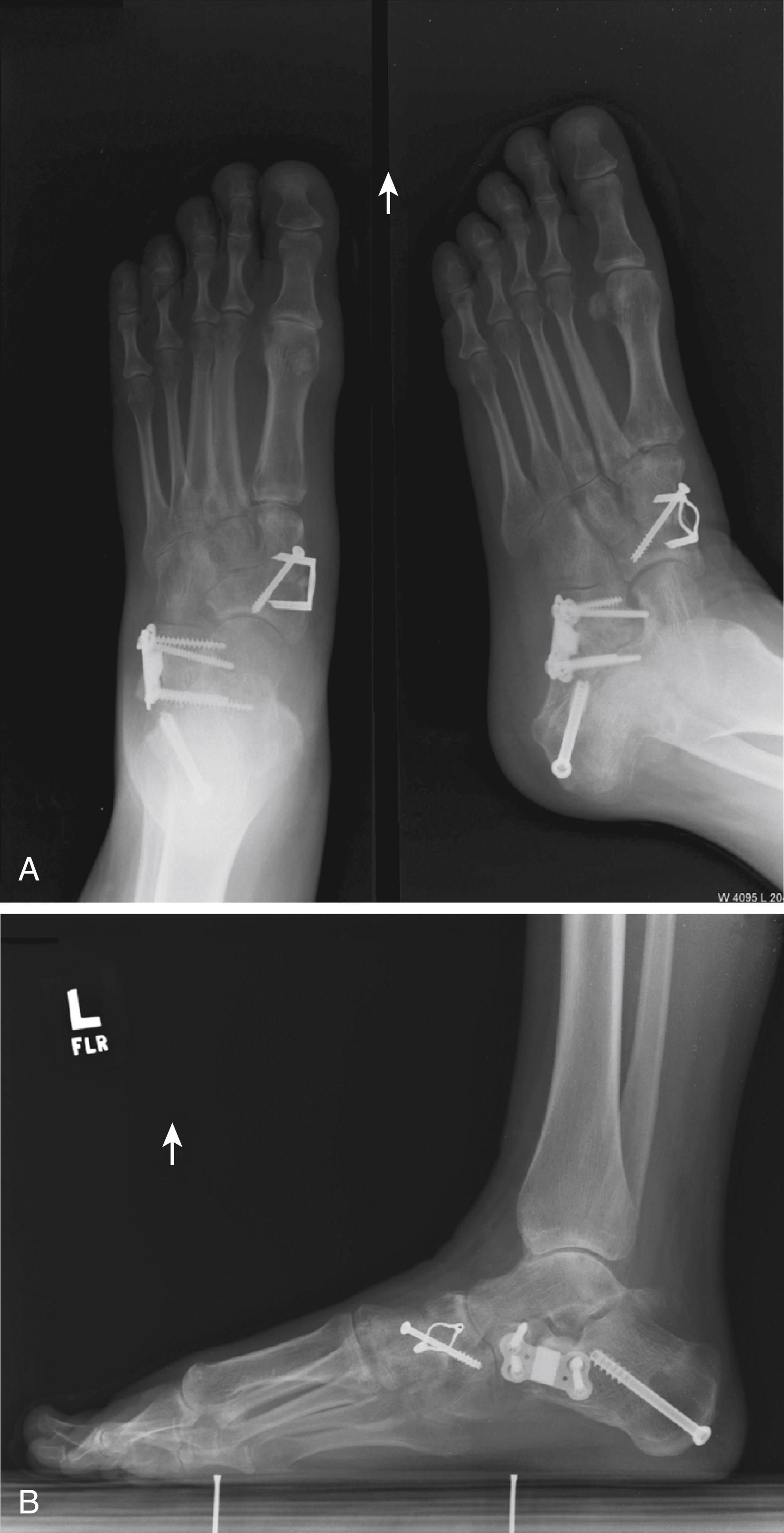 FIGURE 83.26, A and B, Lateral column lengthening with allograft in patient with severe decompensated flatfoot deformity; patient also had medial displacement calcaneal osteotomy and naviculocuneiform arthrodesis. SEE TECHNIQUE 83.5.