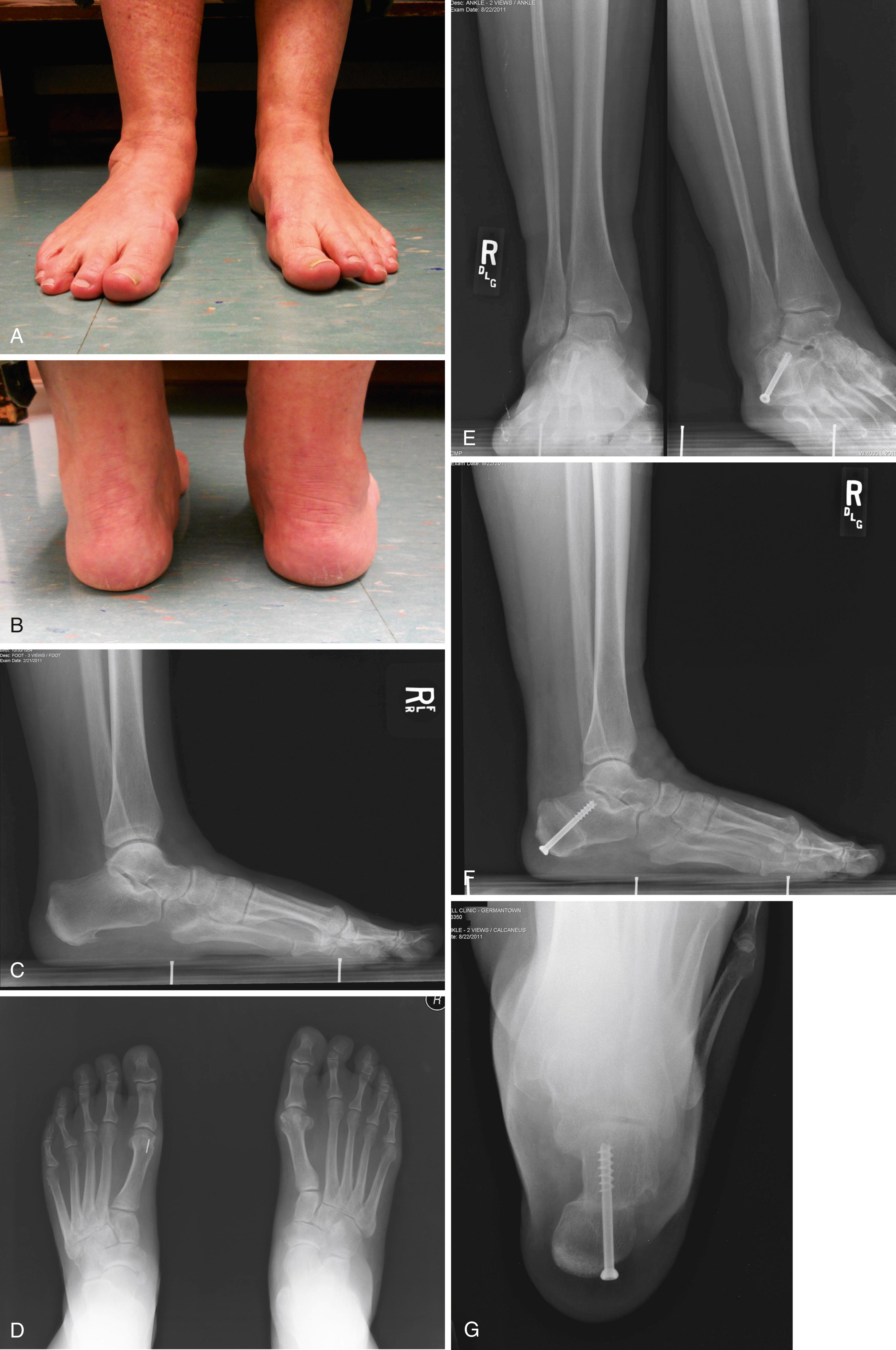 FIGURE 83.28, A and B, Clinical appearance of flatfoot deformity in 39-year-old man; note that midfoot abduction deformity is not severe. C and D, Preoperative radiographs. E to G, After medial calcaneal displacement osteotomy. SEE TECHNIQUE 83.7.