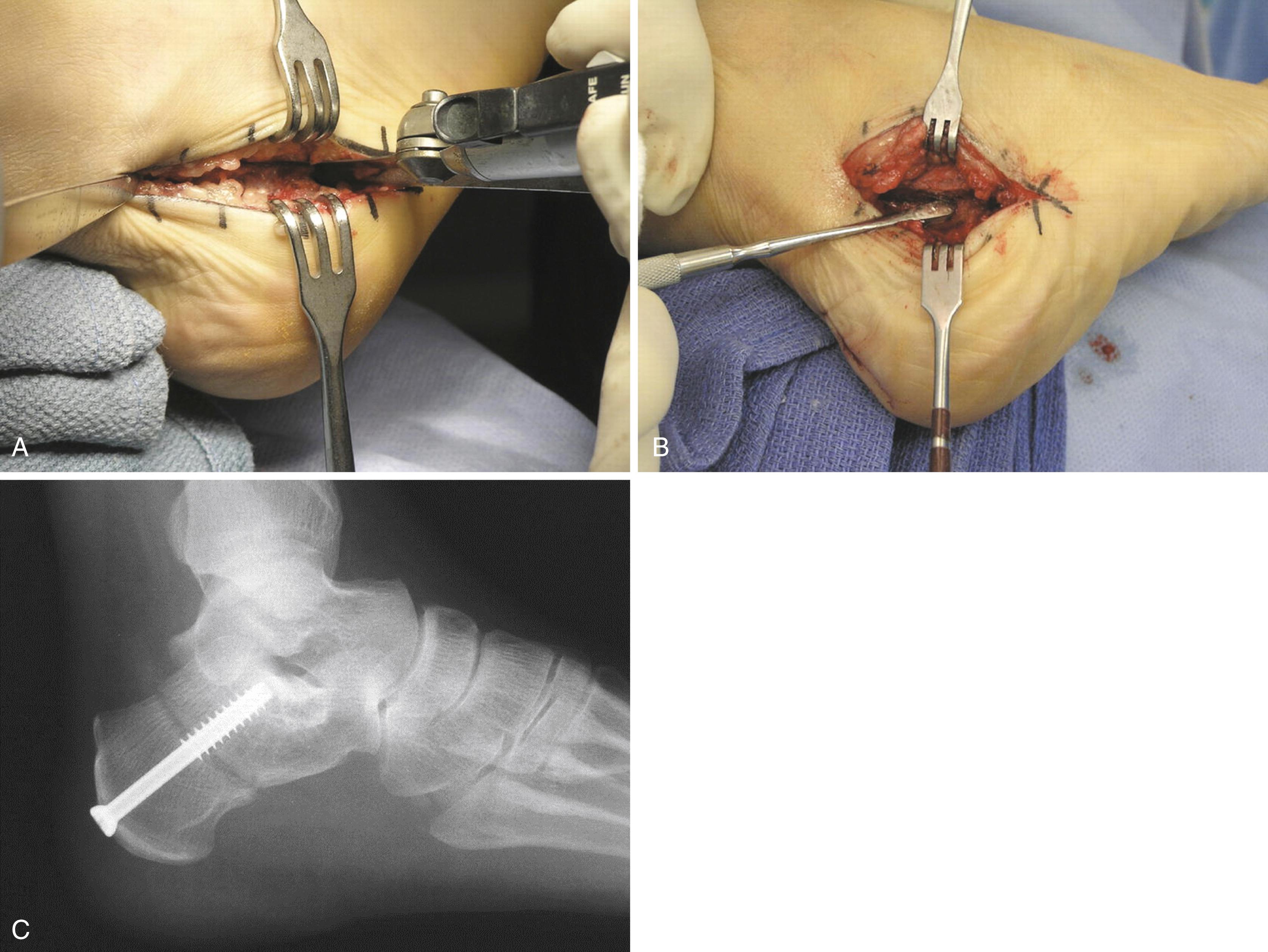 FIGURE 83.29, Medial displacement osteotomy. A, Transverse osteotomy made with oscillating saw. B, Posterior tuberosity displaced medially. C, Fixation with cannulated screw.