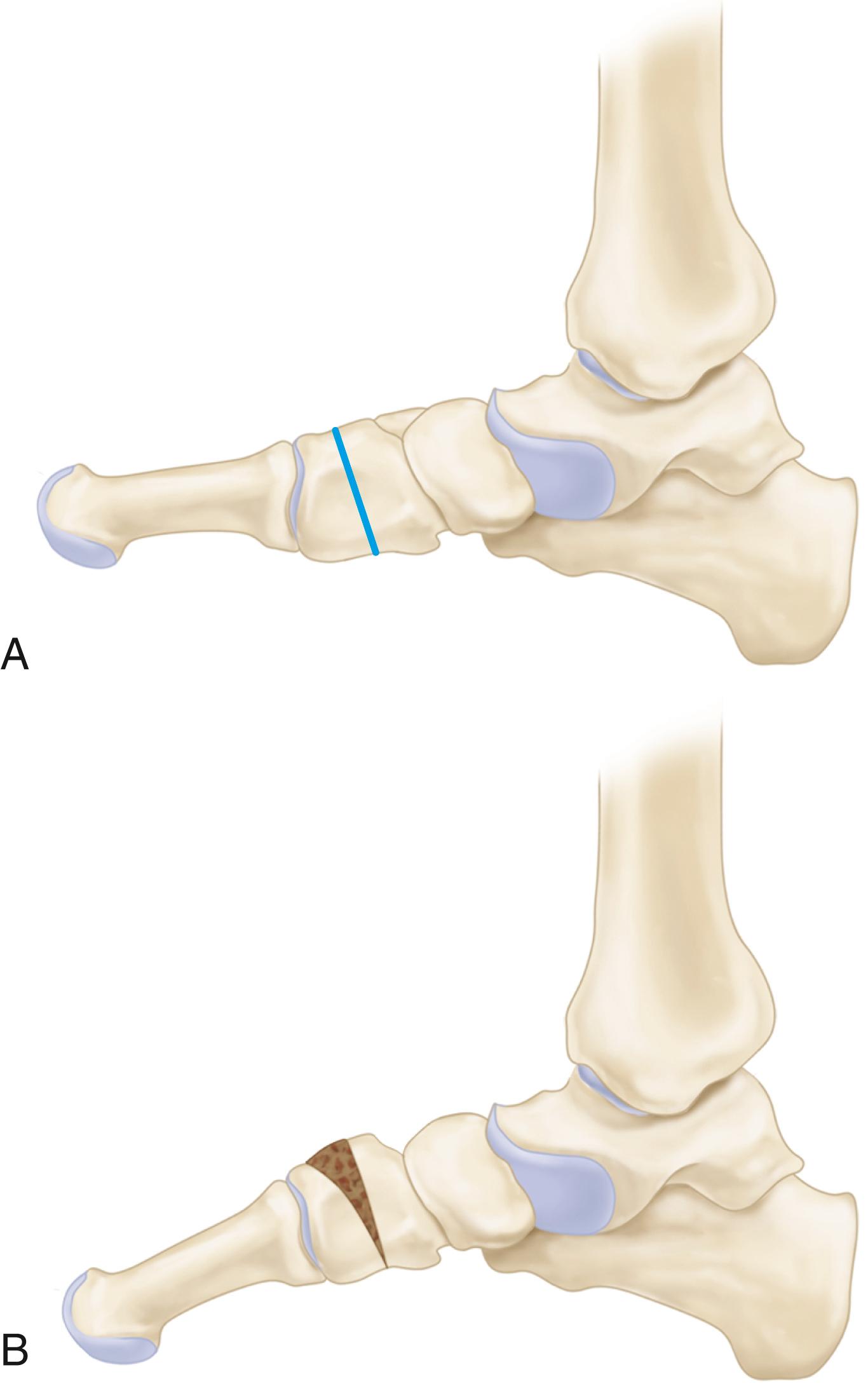 FIGURE 83.31, Opening wedge medial cuneiform osteotomy. A, Location of osteotomy. B, Insertion of bone wedge.