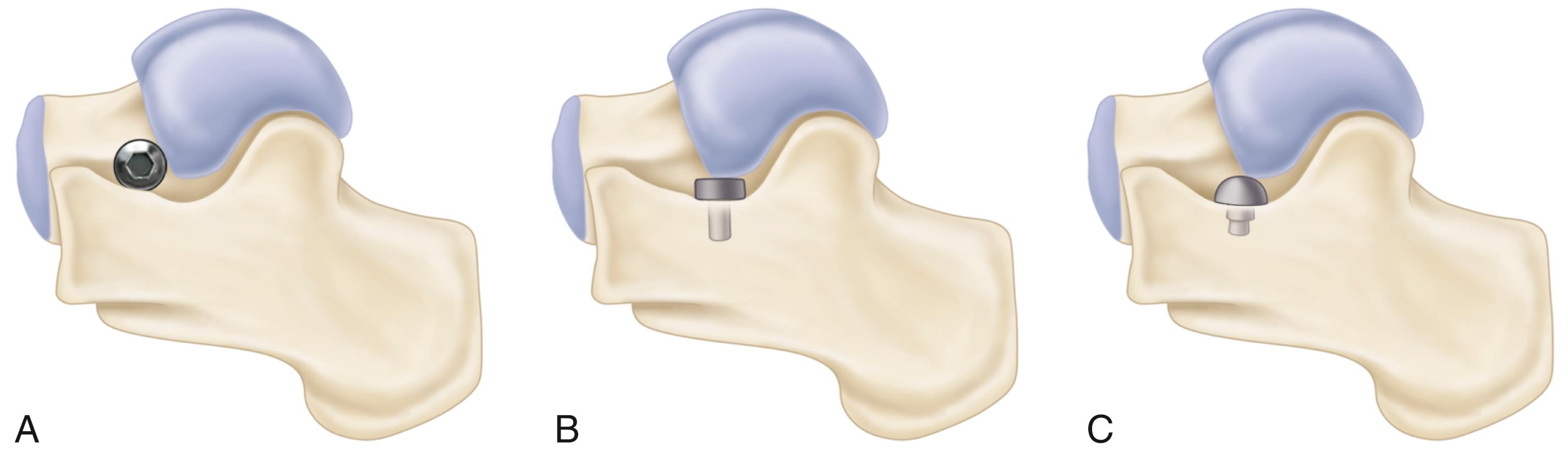 FIGURE 83.33, Maxwell and Cerniglia biomechanical classification of sinus tarsi implants. A, Self-locking wedge. B, Axis-altering device. C, Impact-blocking device.