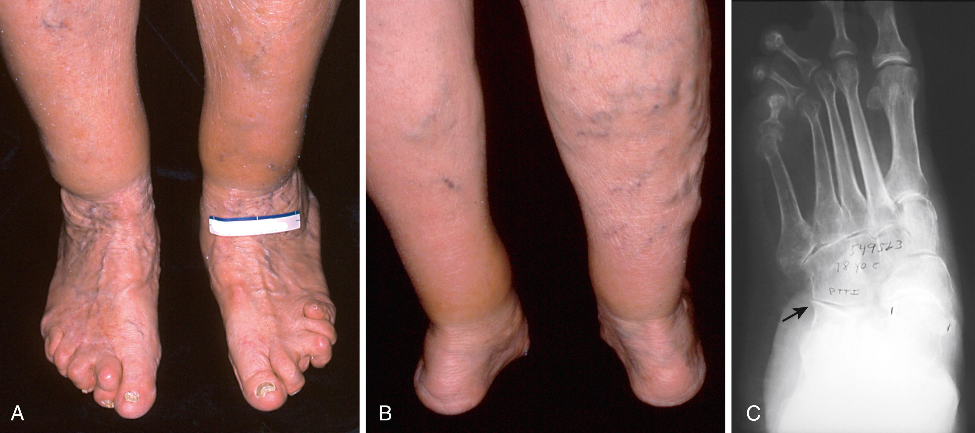 FIGURE 83.34, A, Patient with erosive osteoarthritis and posterior tibial tendon insufficiency. Note fixed hindfoot, midfoot, and forefoot deformities. Patient required triple arthrodesis. B, Posterior clinical view showing marked heel valgus bilaterally, worse on left. C, Weight-bearing anteroposterior view. With this degree of fixed deformity, “reconstructive” triple arthrodesis is required. Bone grafting is frequently needed.