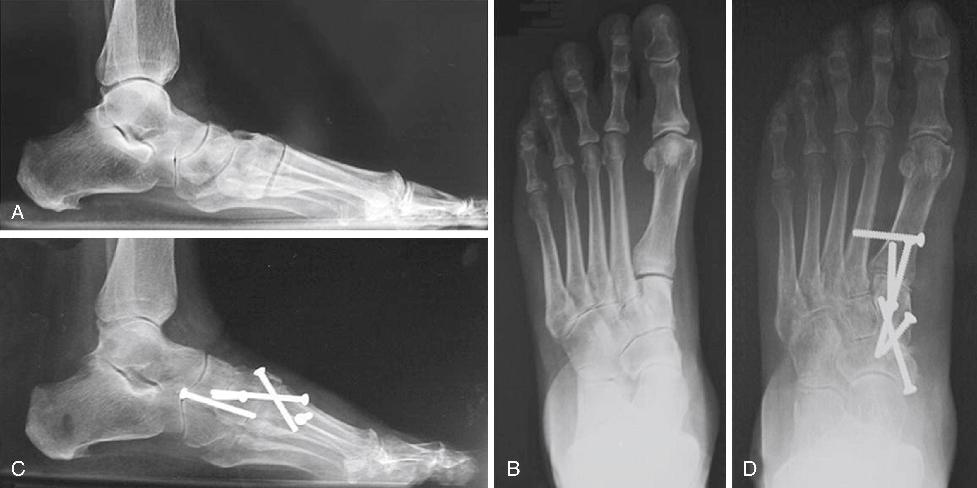 FIGURE 83.35, A, Patient with sag at naviculocuneiform and first tarsometatarsal joints; lateral process of talus is abutting anterior process of calcaneus. B, Varus of first metatarsal is consistent with instability of first tarsometatarsal joint; subluxation of talonavicular joint also is present. C, Lateral view 6 months after medial column arthrodesis shows improvement in talometatarsal angle and opening of sinus tarsi. D, Anteroposterior view shows improved talonavicular coverage.