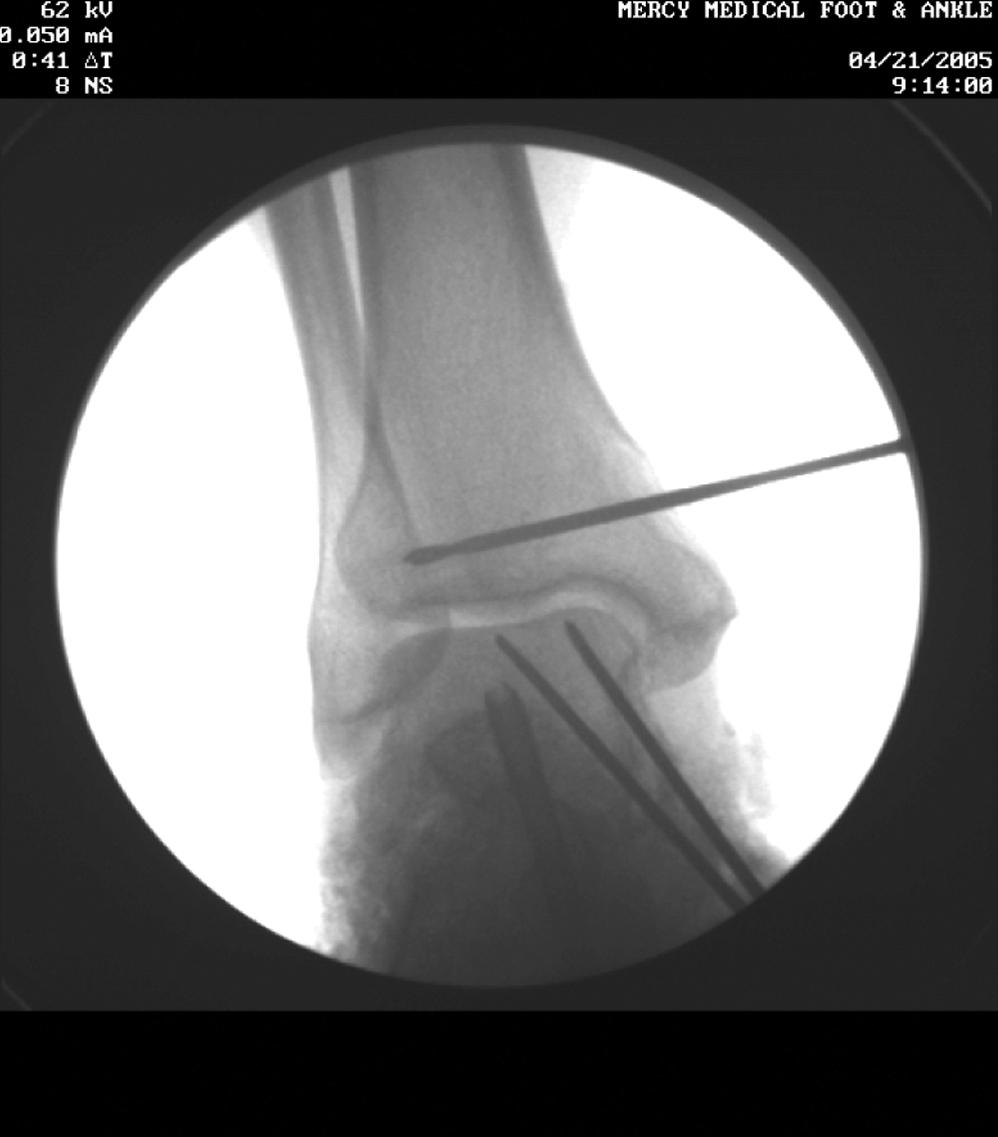 FIGURE 83.36, Reconstruction of deltoid ligament. Fluoroscopic view of guidewire for drilling of tibial tunnel for insertion of tibial limb of reconstruction.