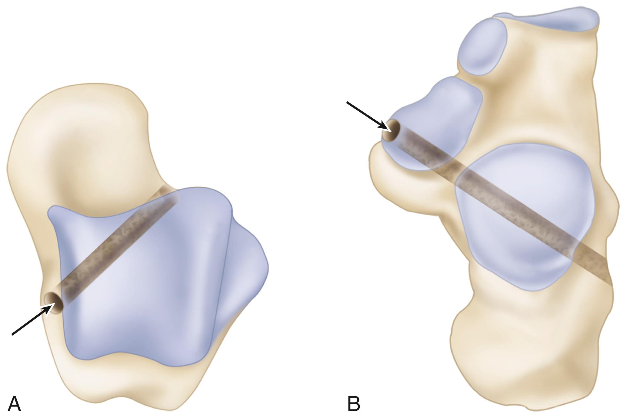 FIGURE 83.37, Reconstruction of deltoid ligament. Disarticulated superior views of talus (A) and calcaneus (B) show path of graft limbs. Arrows indicate entry points. Talar tunnel starts at footprint of deep deltoid ligament and exits at proximal lateral talar neck. Calcaneal tunnel starts at sustentaculum and exits 1 cm superior to peroneal tubercle.