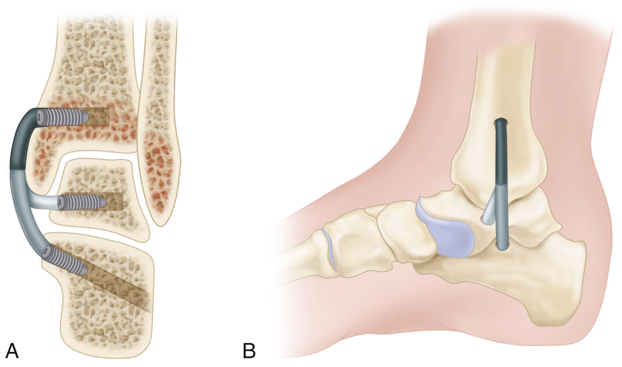 FIGURE 83.38, Coronal (A) and medial (B) views of completed reconstruction of deltoid ligament.