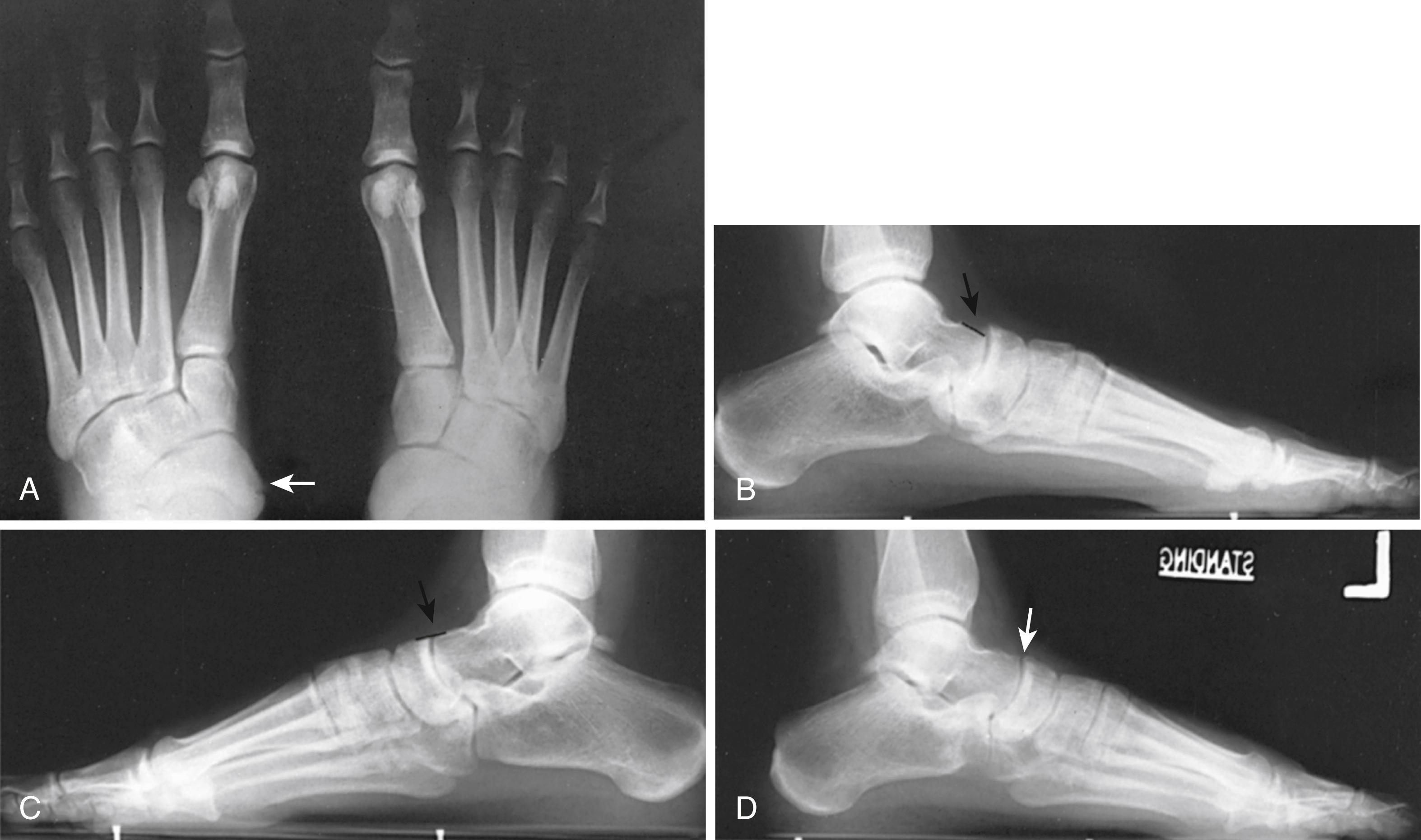 FIGURE 83.39, A, Bilateral cornuate navicular and, on left, accessory navicular (white arrow) in 19-year-old woman. Note on left pronation of forefoot (evidenced by opening up of metatarsal-tarsal joint spaces), apparent widening of intermetatarsal spaces, and uncovering of fibular sesamoid compared with right foot. On standing lateral views of left foot, which had unilateral pes planus, talus is plantarflexed (B) compared with asymptomatic right foot (C). D, After excision of navicular flush with medial cuneiform, advancement of posterior tibial tendon distally, and lengthening of lateral column of foot with calcaneal opening wedge osteotomy (Evans procedure). Talonavicular joint reduced congruously but not with just advancement of posterior tibial tendon.