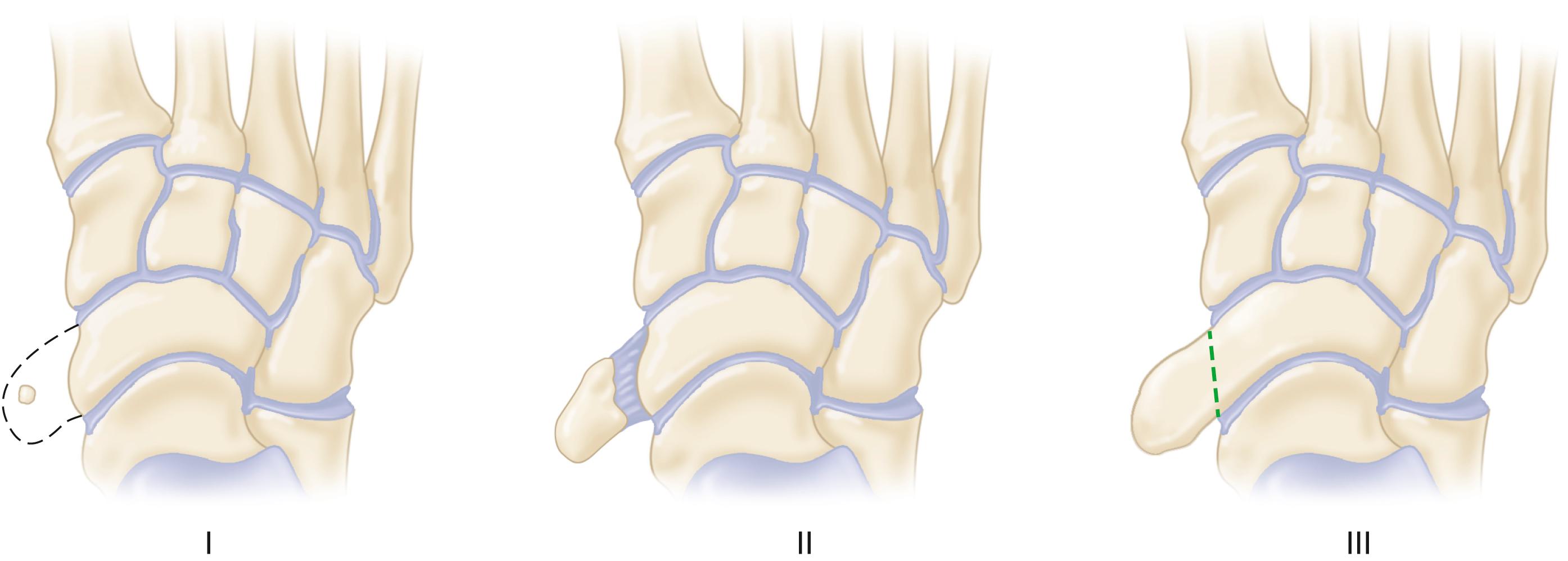 FIGURE 83.40, Classification of accessory navicular. Type I, small oval-to-round ossicle within the posterior tibial tendon; no bony or cartilaginous attachment to the navicular. Type II, larger lateral projection from the medial aspect of the navicular; fibrocartilaginous plate less than 2 mm wide and with an irregular outline separates tuberosity from body of the navicular. Type III, “horn”-shaped prominence connected to the navicular by a bony bridge.