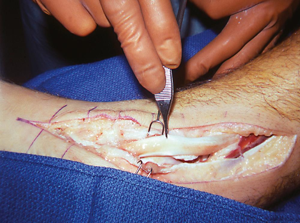 FIGURE 83.4, Patient with mild unilateral pes planus with tenosynovitis that was recalcitrant to all conservative treatment. Inflamed synovium is obvious along tendon, as is continuity of tendon. Loss of excursion and resultant deformity were caused by inflammatory synovial proliferation with its obstructive, painful sequelae at pulley. Radiographs were normal.