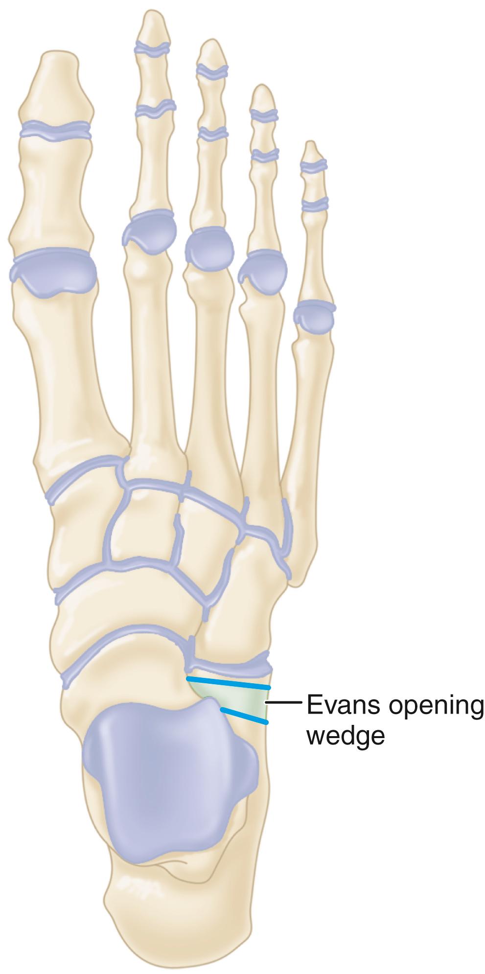 FIGURE 83.41, Evans anterior calcaneal osteotomy helps restore and stabilize longitudinal arch by elongating lateral column of foot.