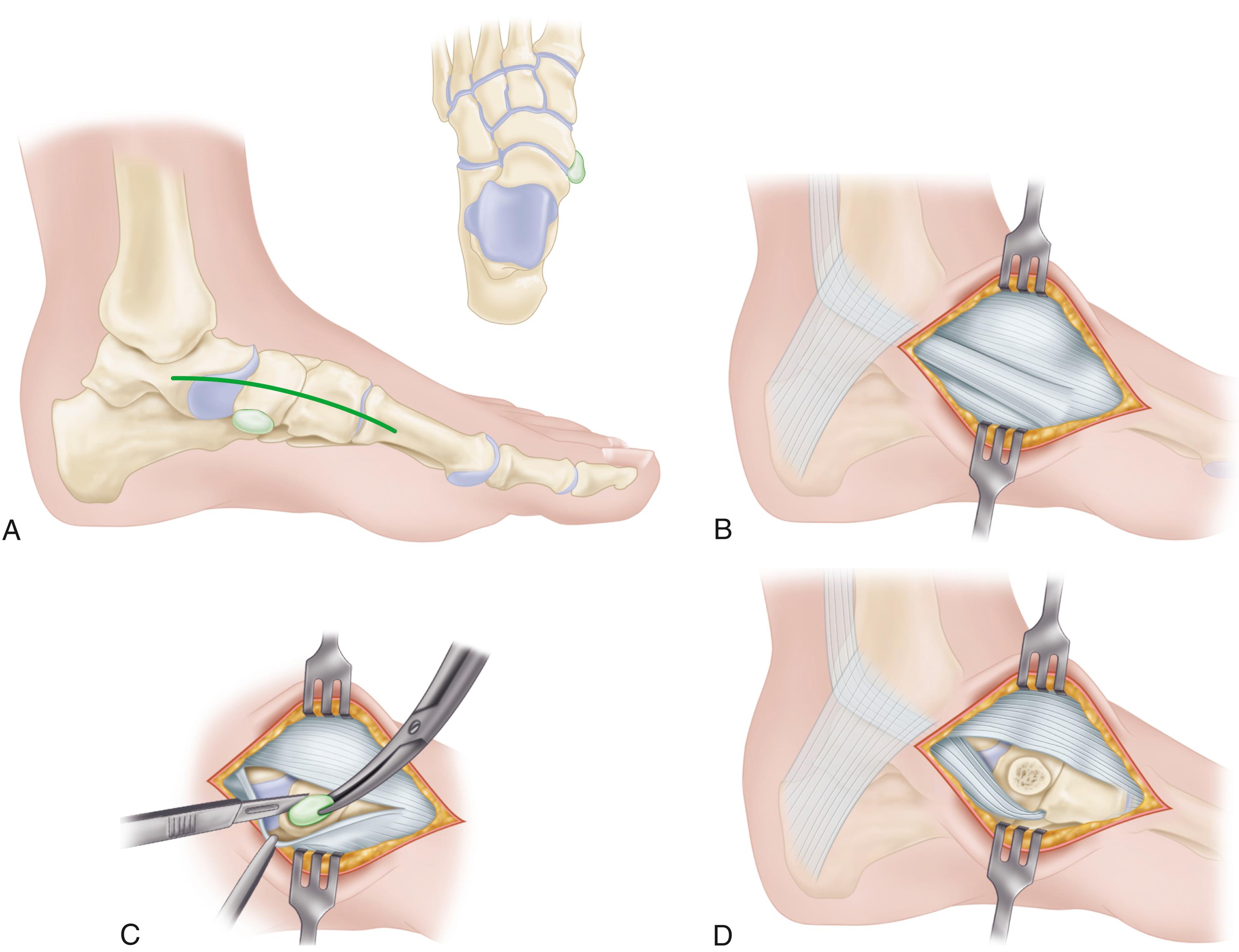 FIGURE 83.42, Kidner procedure. A, Incision. Inset , Location of accessory navicular. B, Exposure of posterior tibial tendon and accessory navicular. C, Removal of accessory navicular. D, Accessory navicular removed and tuberosity of navicular cut flush with adjacent cuneiform and talus. SEE TECHNIQUE 83.11.