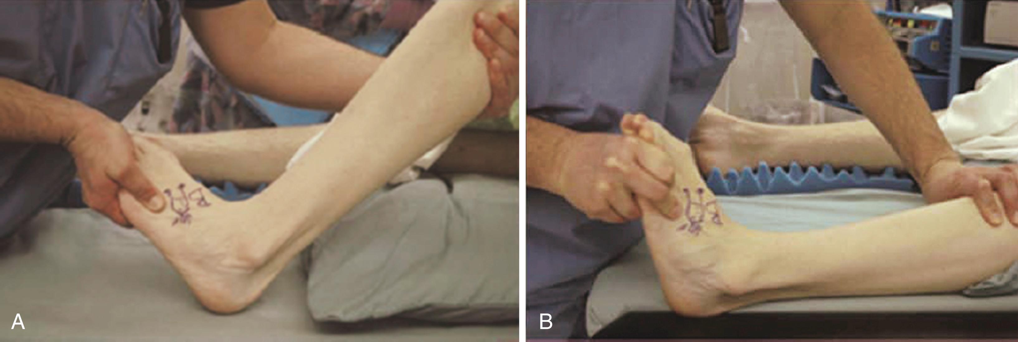 FIGURE 83.5, Silfverskiöld test to determine selective gastrocsoleus muscle tightness and contracture. Passive range of dorsiflexion of ankle is measured with knee flexed (A) and extended (B). Significant reduction of dorsiflexion with knee extended may indicate need for gastrocnemius recession.