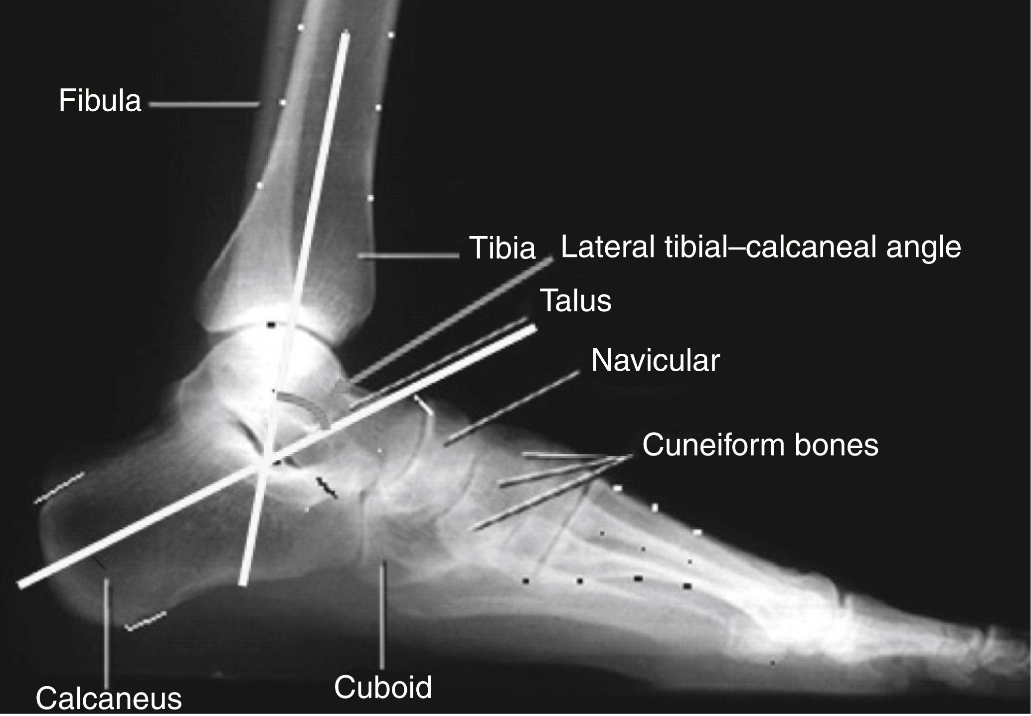 FIGURE 83.6, Measurement of standing lateral tibial-calcaneal angle (see text).