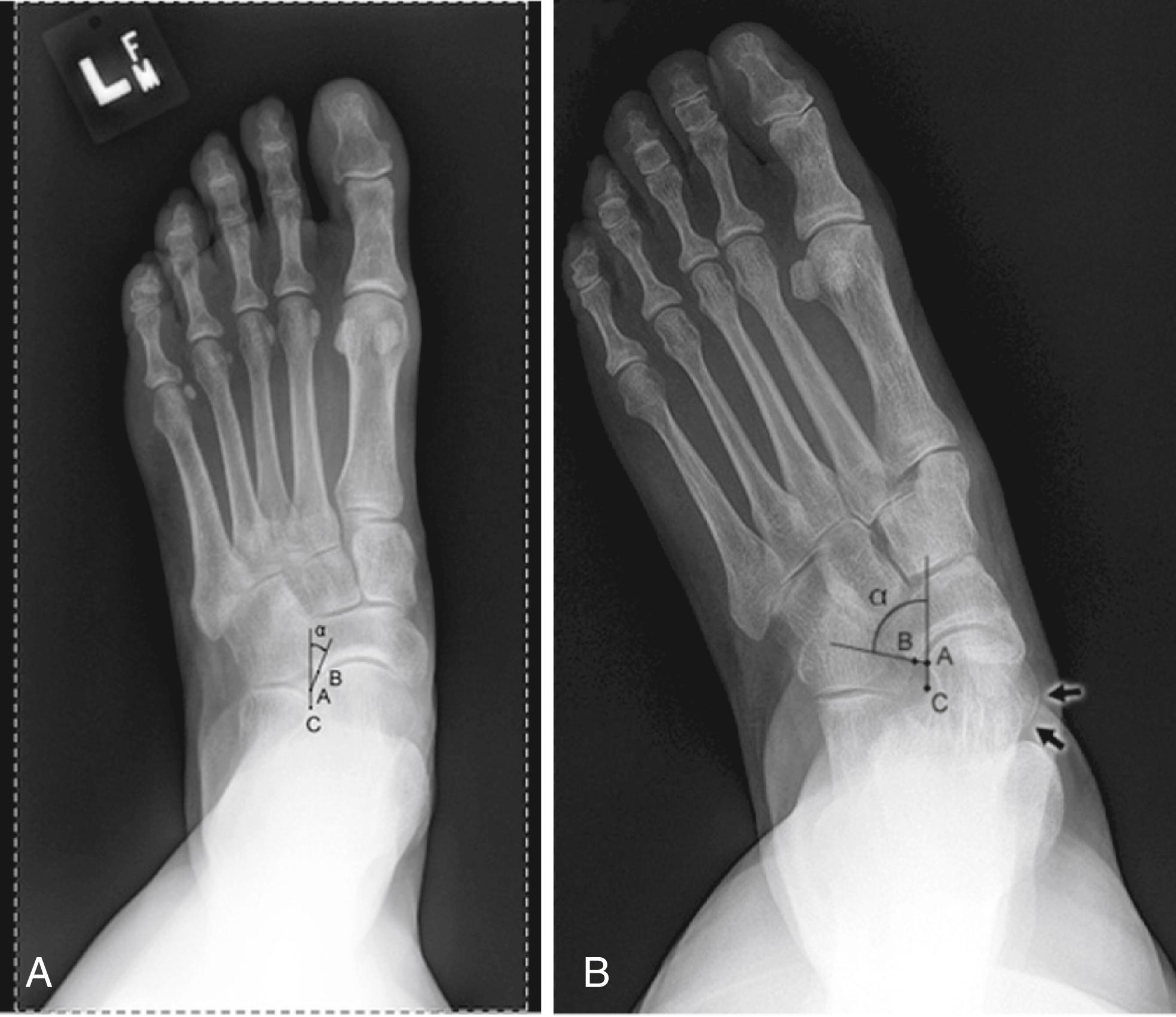 FIGURE 83.7, Incongruency angle is determined by drawing line joining lateral extent of talar articular surface (point A) and lateral extent of navicular surface (point B). Second line is drawn between lateral aspect of talar neck at its narrowest segment (point C) and lateral extent of talar articular surface (point A). Distal and lateral interval between these two lines forms incongruency angle. A, Incongruency angle in normal foot. B, Incongruency angle in type IIb flatfoot deformity.