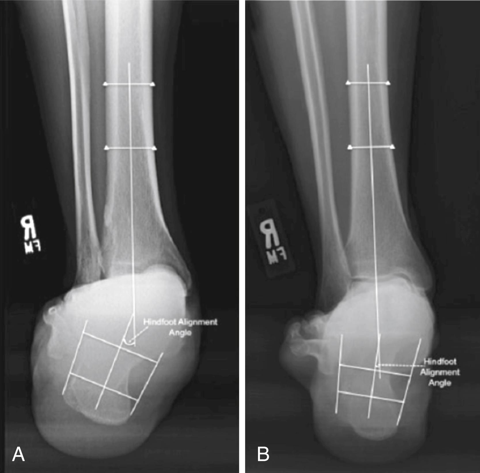 FIGURE 83.8, Depiction of hindfoot alignment angle measurements taken on a patient with flatfoot (A) and normal control patient (B) .