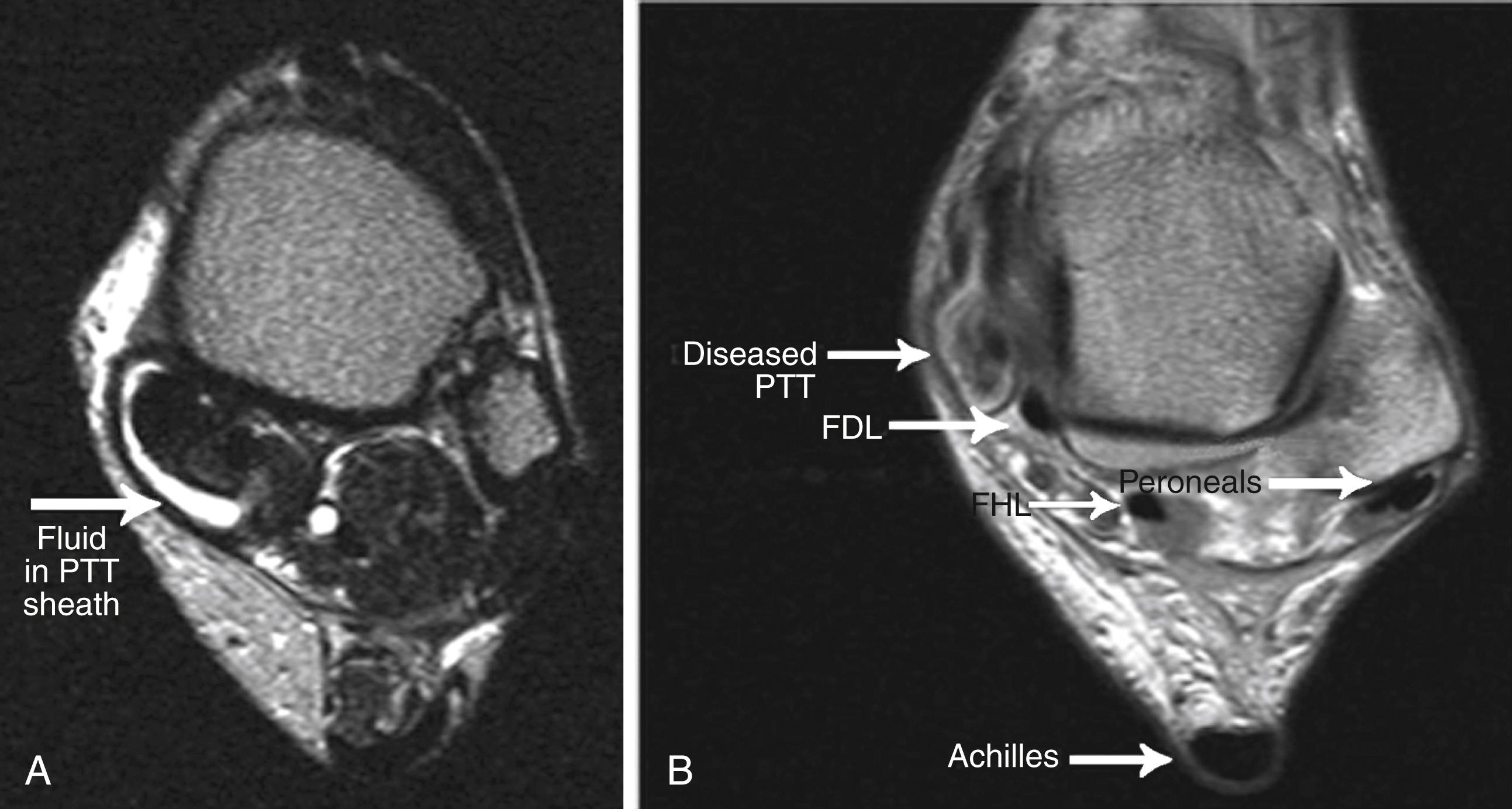 FIGURE 83.9, Magnetic resonance imaging is helpful to identify peritendinous effusion (A) and degeneration within the tendon (B) .