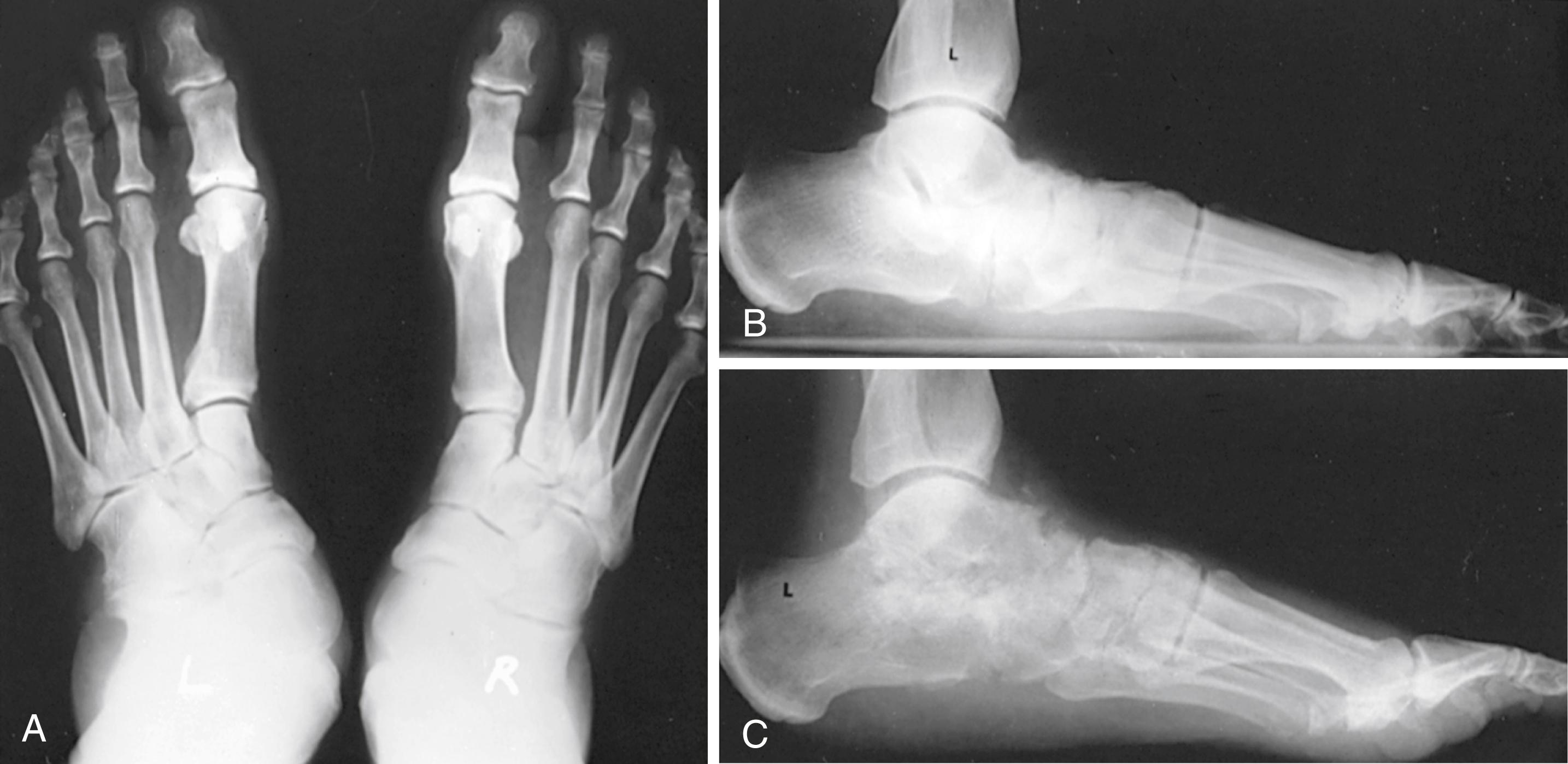 FIGURE 83.10, On anteroposterior view of both feet, note in symptomatic left foot uncovering of talar head as navicular and remaining part of foot move laterally into abduction. Intermetatarsal spaces at their base appear slightly widened; metatarsal-tarsal articulations appear in fact better than in right asymptomatic foot as result of pronation of forefoot. A, Divergence of anteroposterior talocalcaneal angle (Kite angle) is present. B, Standing lateral view shows plantarflexion of talus (head of talus moves plantarward, medially, and distally), loss of normal calcaneal pitch (and concomitant tightening of Achilles tendon), secondary collapse of navicular-cuneiform articular surfaces, and overlapping of medial four metatarsals from pronation of forefoot in weight-bearing position. This patient had traumatic rupture of posterior tibial tendon many years previously while engaging in sports. C, Traumatic arthritic changes followed, and eventually triple arthrodesis was required.