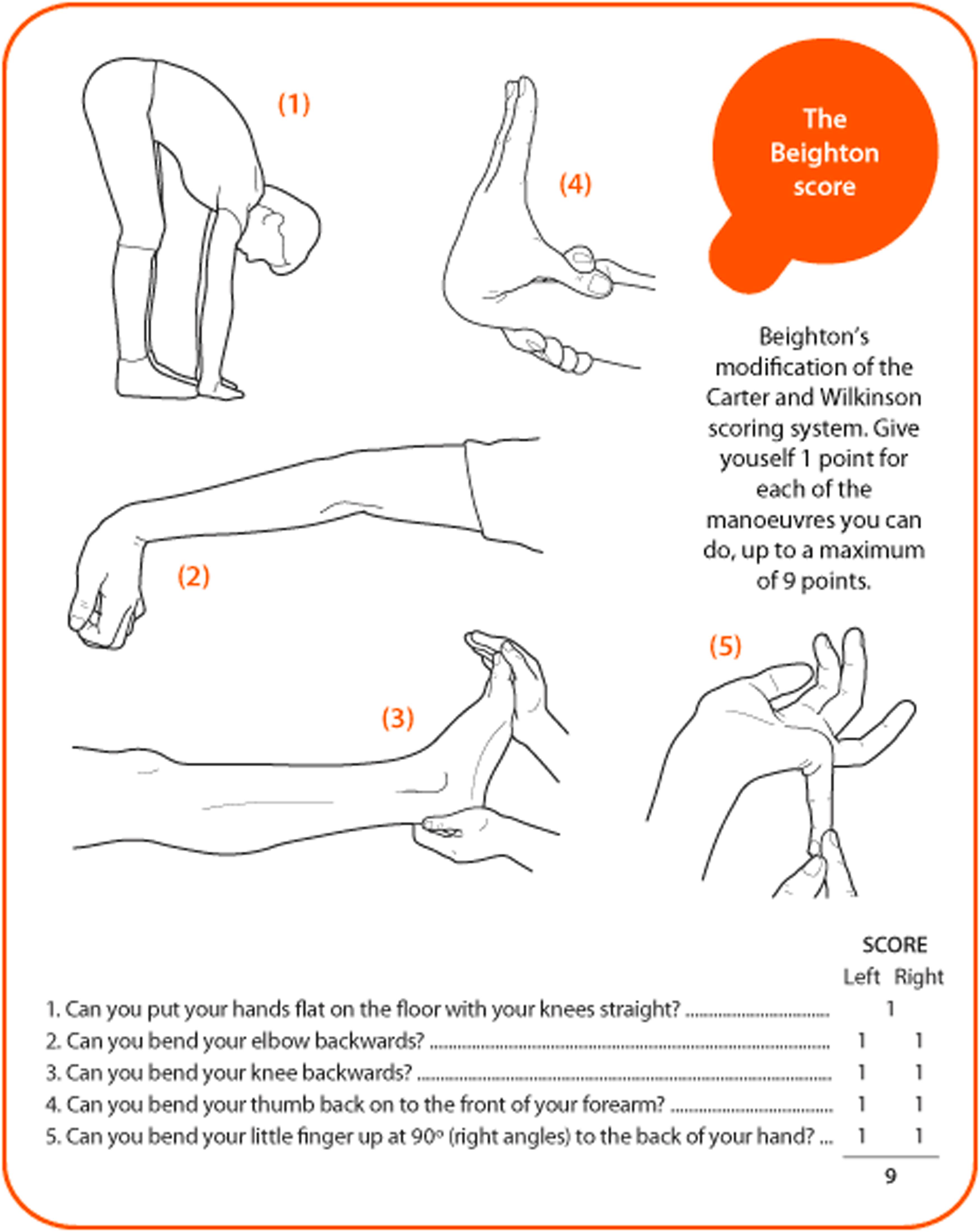 Figure 13.4, Beighton Score for Joint Hypermobility assessment. Degree of mobility assessed by passive maneuvers in 5 joints. Total score: 0–9. Hypermobility score: ≥5.