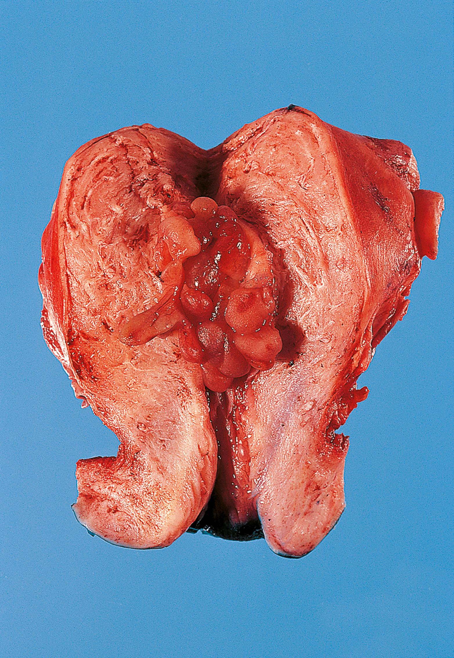 E-Fig. 6.1 G, Endometrial hyperplasia. The whole lining of the endometrial cavity appears polypoid due to excessive oestrogenic stimulation. As a result, patients often present with menorrhagia (heavy menstruation) or post menopausal bleeding.