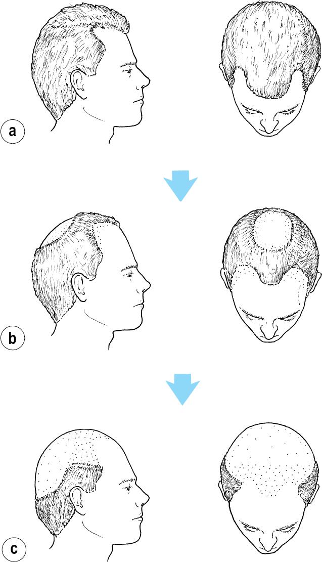 Fig. 38.1, Male pattern baldness.