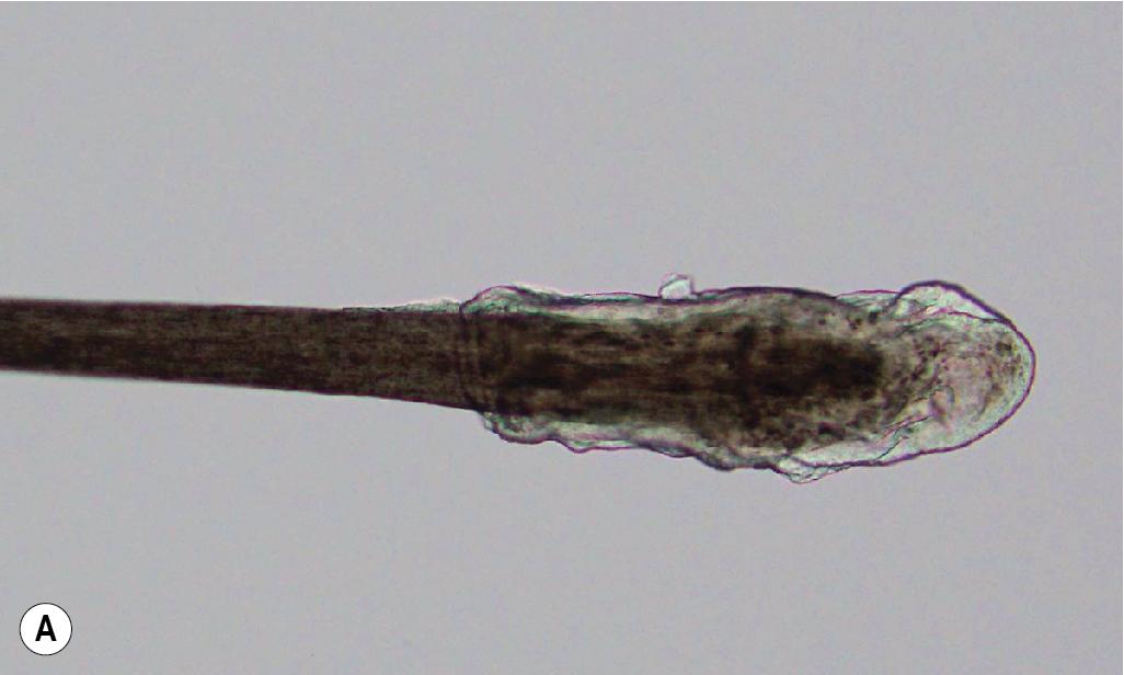 Fig. 7.1, Stages of growth of the hair root. (A) Anagen hairs are the growing hairs that comprise 90% of hair at any time and persist for several years. Anagen hairs are pigmented and have a translucent sheath. (B) Telogen hairs are in a resting phase that persists for 3 months. Note the small bulb and lack of sheath.