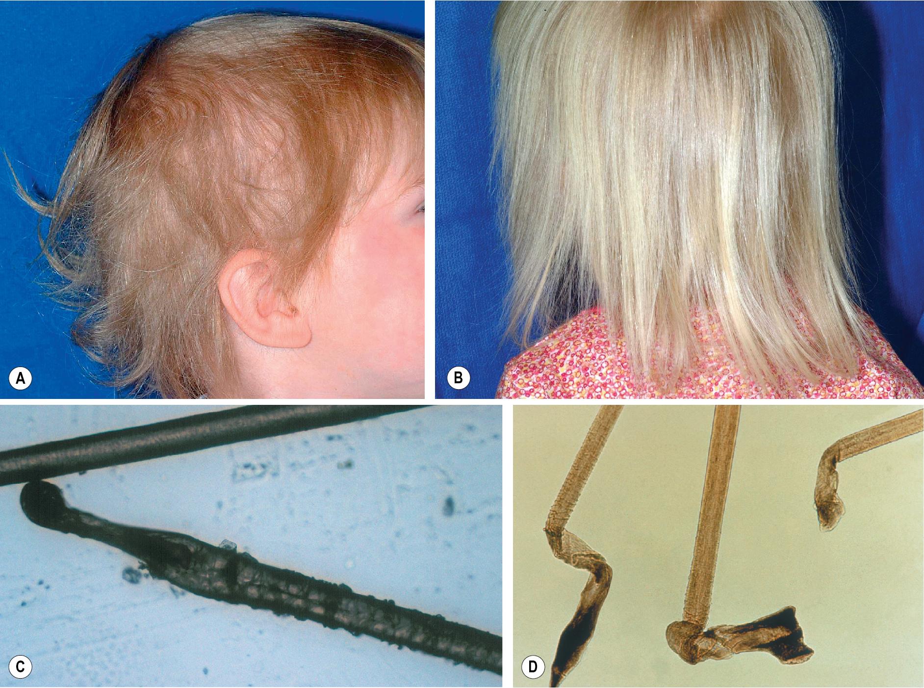 Fig. 7.11, Loose anagen syndrome. (A, B) The typical patient is a blonde preschool girl whose hair comes out easily and has become lusterless, fine, sparse, and uneven. When viewed under light microscope, the hairs that are easily able to be removed without plucking show a ruffled cuticle (C) and distorted bulb (D) .