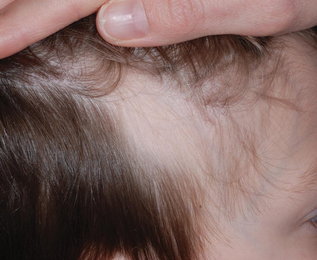 Fig. 7.12, Congenital triangular alopecia. This triangular patch of alopecia may not appear until 2 to 3 years of age or even later but then persists unchanged.